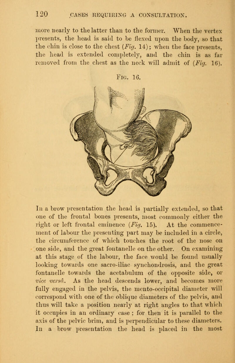 more nearly to the latter than to the former. AVhen the vertex presents, the head is said to be flexed upon the body, so that the chin is close to the chest {Fig. 14); when the face presents, the head is extended completely, and the chin is as far removed from the chest as the neck will admit of [Fig. 16). Fig. 16. In a brow presentation the head is partially extended, so that one of the frontal bones presents, most commonly either the right or left frontal eminence {Fig. 15). At the commence- ment of labour the presenting part may be included in a circle, the circumference of which touches the root of the nose on one side, and the great fontanelle on the other. On examining at this stage of the labour, the face would be found usually looking towards one sacro-iliac synchondrosis, and the great fontanelle towards the acetabulum of the opposite side, or vice versa. As the head descends lower, and becomes more fully engaged in the pelvis, the mento-occipital diameter will correspond with one of the oblit^ue diameters of the pelvis, and thus will take a position nearly at right angles to that which it occupies in an ordinary case ; for then it is parallel to the axis of the pelvic brim, and is perpendicular to these diameters. In a brow i>resentation the head is placed in the most