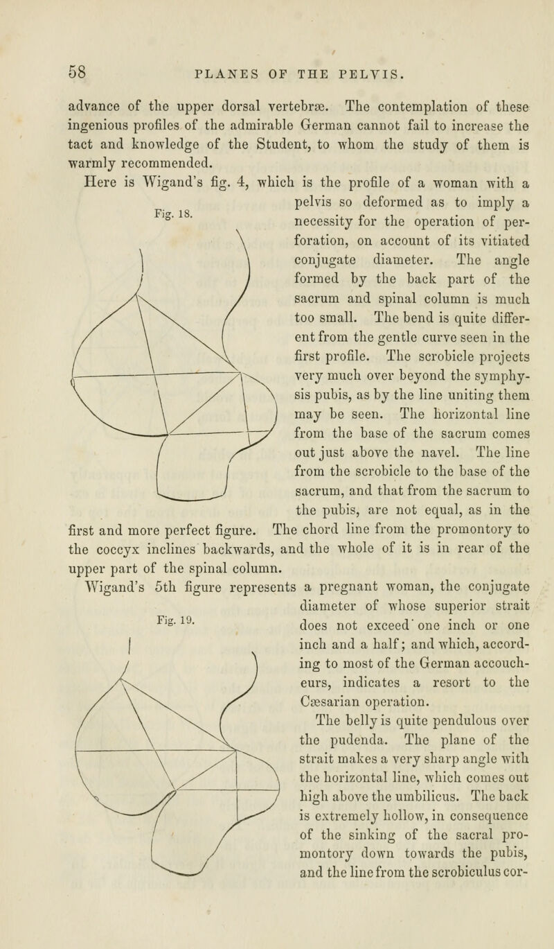 advance of the upper dorsal vertebrae. The contemplation of these ingenious profiles of the admirable German cannot fail to increase the tact and knowledge of the Student, to whom the study of them is warmly recommended. Here is Wigand's fig. 4, which is the profile of a woman with a pelvis so deformed as to imply a necessity for the operation of per- foration, on account of its vitiated conjugate diameter. The angle formed by the back part of the sacrum and spinal column is much too small. The bend is quite differ- ent from the gentle curve seen in the first profile. The scrobicle projects very much over beyond the symphy- sis pubis, as by the line uniting them may be seen. The horizontal line from the base of the sacrum comes out just above the navel. The line from the scrobicle to the base of the sacrum, and that from the sacrum to the pubis, are not equal, as in the first and more perfect figure. The chord line from the promontory to the coccyx inclines backwards, and the whole of it is in rear of the upper part of the spinal column. Wigand's 5th figure represents a pregnant woman, the conjugate diameter of whose superior strait does not exceed'one inch or one inch and a half; and which, accord- ing to most of the German accouch- eurs, indicates a resort to the Caesarian operation. The belly is quite pendulous over the pudenda. The plane of the strait makes a very sharp angle with the horizontal line, which comes out high above the umbilicus. The back is extremely hollow, in consequence of the sinking of the sacral pro- montory doAvn towards the pubis, and the line from the scrobiculus cor- Fig. 19.