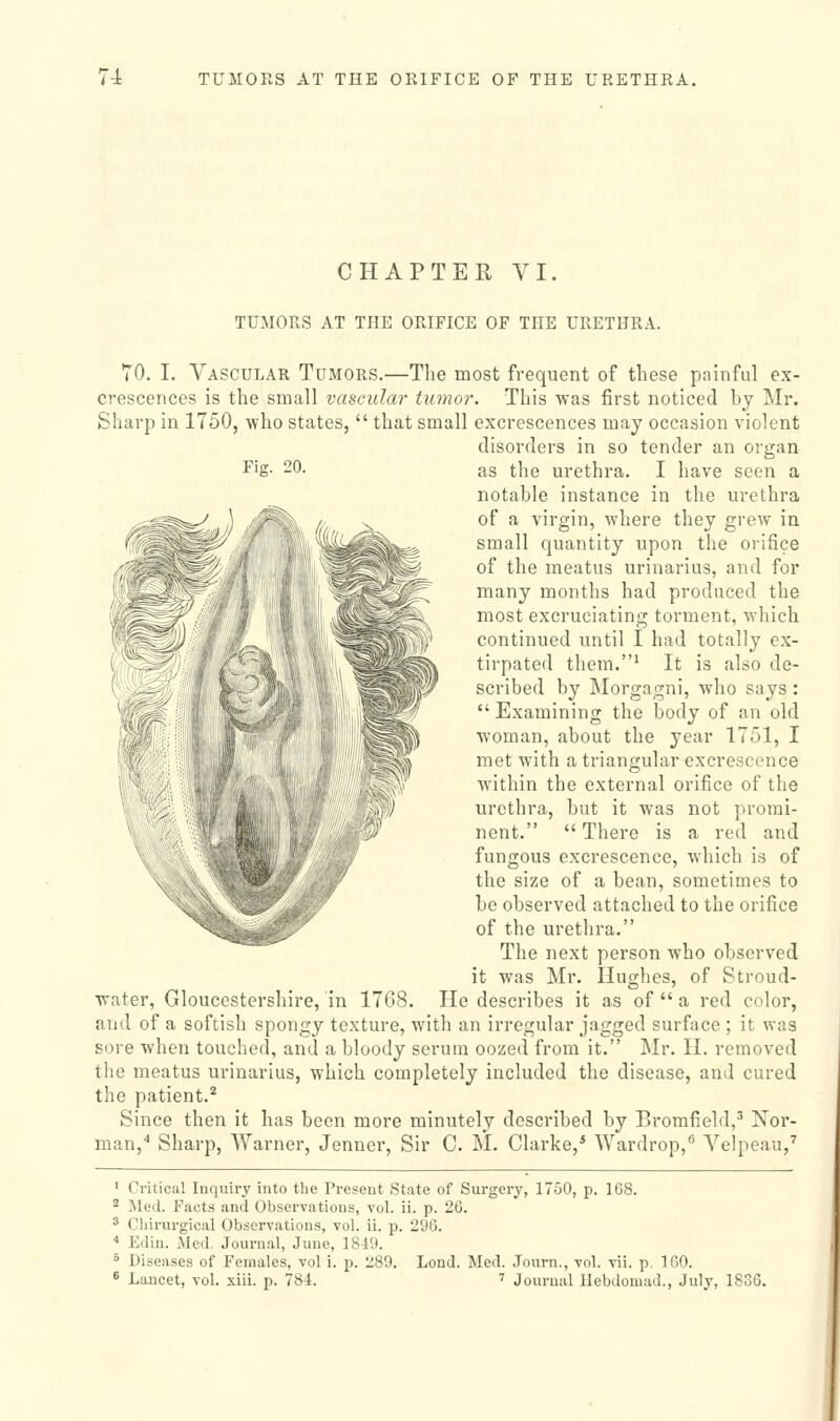 CHAPTER VI TUMORS AT THE ORIFICE OF THE URETHRA. TO. I. Vascular Tumors.—The most frequent of these pninful ex- crescences is the small vascular tumor. This was first noticed by Mr. Sharp in 1750, who states,  that small excrescences may occasion violent disorders in so tender an organ Fig. 20. as the urethra. I have seen a notable instance in the urethra of a virgin, where they grew in small quantity upon the orifice of the meatus urinarius, and for many months had produced the most excruciating torment, which continued until I had totally ex- tirpated them.^ It is also de- scribed by Morgagni, who says :  Examining the body of an old woman, about the year 1751, I met with a triangular excrescence within the external orifice of the urethra, but it was not promi- nent.  There is a red and fungous excrescence, which is of the size of a bean, sometimes to be observed attached to the orifice of the urethra. The next person who observed it was Mr. Hughes, of Stroud- water, Gloucestershire, in 1768. He describes it as of  a red color, and of a softish spongy texture, with an irregular jagged surface ; it was sore when touched, and a bloody serum oozed from it. Mr. H. removed the meatus urinarius, which completely included the disease, and cured the patient.^ Since then it has been more minutely described by Bromfield,^ Nor- man,'* Sharp, Warner, Jenner, Sir C. M. Clarke,* Wardrop,'' Velpeau,'' Critical Inquiry into the Present State of Surgery, 1750, p. 168. Med. Facts and Observations, vol. ii. p. 26. Chirurgical Observations, vol. ii. p. 296. Edin. Med. Journal, June, 184'J. Diseases of Females, vol i. p. 289 Lancet, voL xiii. p. 784. Lond. Med. Journ., vol. vii. p, 160. '' Journal Hebdomad., July, 1836.