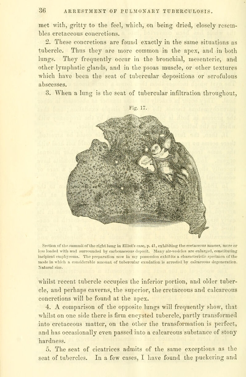 met with, gritty to the feel, which, on being dried, closely resem- bles cretaceous concretions. 2. These concretions are found exactly in the same situations as tubercle. Thus they are more common in the apex, and in both lungs. They frequently occur in the bronchial, mesenteric, and other lymphatic glands, and in the psoas muscle, or other textures which have been the seat of tubercular depositions or scrofulous abscesses. 3. When a lung is the seat of tubercular infiltration throughout, Fi- 1^ ^f>;^*% (fh>. Section of the summit of the right lung in Elliot's case, p. 41, exhibiting the cretaceous masses, more or loss loaded with and surrounded by carbonaceous deposit. Many air-vesicles are enlarged, constituting incipient emphysema. The preparation now in my possession exhibits a characteristic specimen of the mode in which a considerable amount of tubercular exudation is arrested by calcareous degeneration. Natural size. whilst recent tubercle occupies the inferior portion, and older tuber- cle, and perhaps caverns, the superior, the cretaceous and calcareous concretions will be found at the apex. 4. A comparison of the opposite lungs will frequently show, that whilst on one side there is firm encysted tubercle, partly transformed into cretaceous matter, on the other the transformation is perfect, and has occasionally even passed into a calcareous substance of stony hardness. 5. The seat of cicatrices admits of the same exceptions as the seat of tubercles. In a few cases, I have found the puckering and