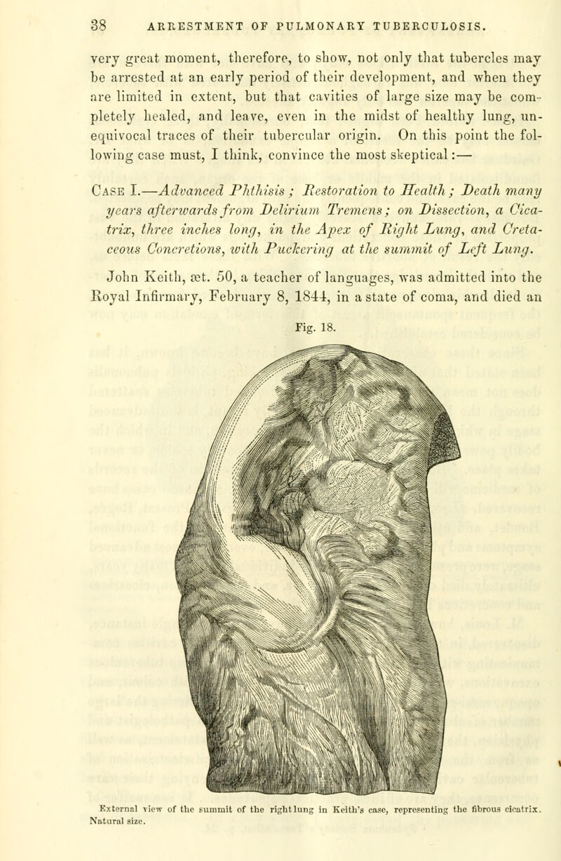 vei'j great moment, therefore, to show, not only that tubercles may be arrested at an early period of their development, and when they are limited in extent, but that cavities of large size may be com- pletely healed, and leave, even in the midst of healthy lung, un- equivocal traces of their tubercular origin. On this point the fol- lowing case must, I think, convince the most skeptical:— Case I.—Advanced Phthisis ; Bestoration to Health ; Death many years afterivards from Delirium Tremens; on Dissection^ a Cica- trix, three inches long, in the Apex of Right Lung, and Creta- ceous Concretions, with Puclccring at the summit of Left Lung. John Keith, £et. 50, a teacher of languages, was admitted into the Royal Infirmary, February 8, 1844, in a state of coma, and died an Fig. 18. External \iew of the summit of the rishtlung Natural size. Keith's case, representing the fibrouf? cicatrix.
