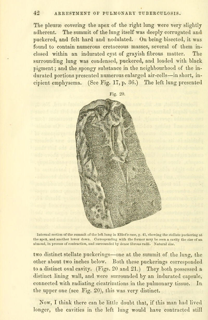 The pleurjB covering the apex of the right lung were very slightly adherent. The summit of the lung itself was deeply corrugated and puckered, and felt hard and nodulated. On being bisected, it was found to contain numerous cretaceous masses, several of them in- closed within an indurated cyst of grayish fibrous matter. The surrounding lung was condensed, puckered, and loaded with black pigment; and the spongy substance in the neighbourhood of the in- durated portions presented numerous enlarged air-cells—in short, in- cipient emphysema. (See Fig. 17, p. 36.) The left lung presented Fis. 20. Internal section of the summit of the left lung in Elliot's case, p. 41, showing the stellate puckering at the apex, and another lower down. Corresponding with the former may be seen a cavity the size of an almond, in process of contraction, and surrounded by dense fibrous radii. Natural size. two distinct stellate puckerings—one at the summit of the lung, the other about two inches below. Both these puckerings corresponded to a distinct oval cavity. (Figs. 20 and 21.) They both possessed a distinct lining wall, and were surrounded by an indurated capsule, connected with radiating cicatrizations in the pulmonary tissue. In the upper one (see Fig. 20), this was very distinct. Now, I think there can be little doubt that, if this man had lived longer, the cavities in the left lung would have contracted still