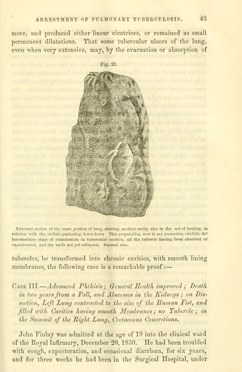 more, and produced cither linear cicatrices, or remained as small permanent dilatations. That some tubercular ulcers of the lung, even when very extensive, may, by the evacuation or absorption of Fig. 21. ^1 External section of the same portion of lung, showing another cavity also in the act of healing, in relation with the stellate puckering, lower down. This preparation, now in my possession, exhibits the intermediate stage of cicatrization in tubercular cavities, all the tubercle having been absorbed or expectorated, and the walls not yet collapsed. Natural size, tubercles, be transformed into chronic cavities, with smooth lining membranes, the following case is a remarkable proof:— Case III.—Advanced Phthisis ; Creneral Health improved ; Death in tivo years from a Fall, and Abscesses in the Kidneys ; on Dis- section, Left Lung contracted to the size of the Human Fist, and filled with Cavities having smooth Membranes ; no Tubercle ; in the Summit of the Right Lung, Cretaceous Concretions. John Finlay was admitted at the age of 19 into the clinical ward of the Royal Infirmary, December 20,1850. He had been troubled with cough, expectoration, and occasional diarrhoea, for six years, and for three weeks he had been in the Surgical Hospital, under