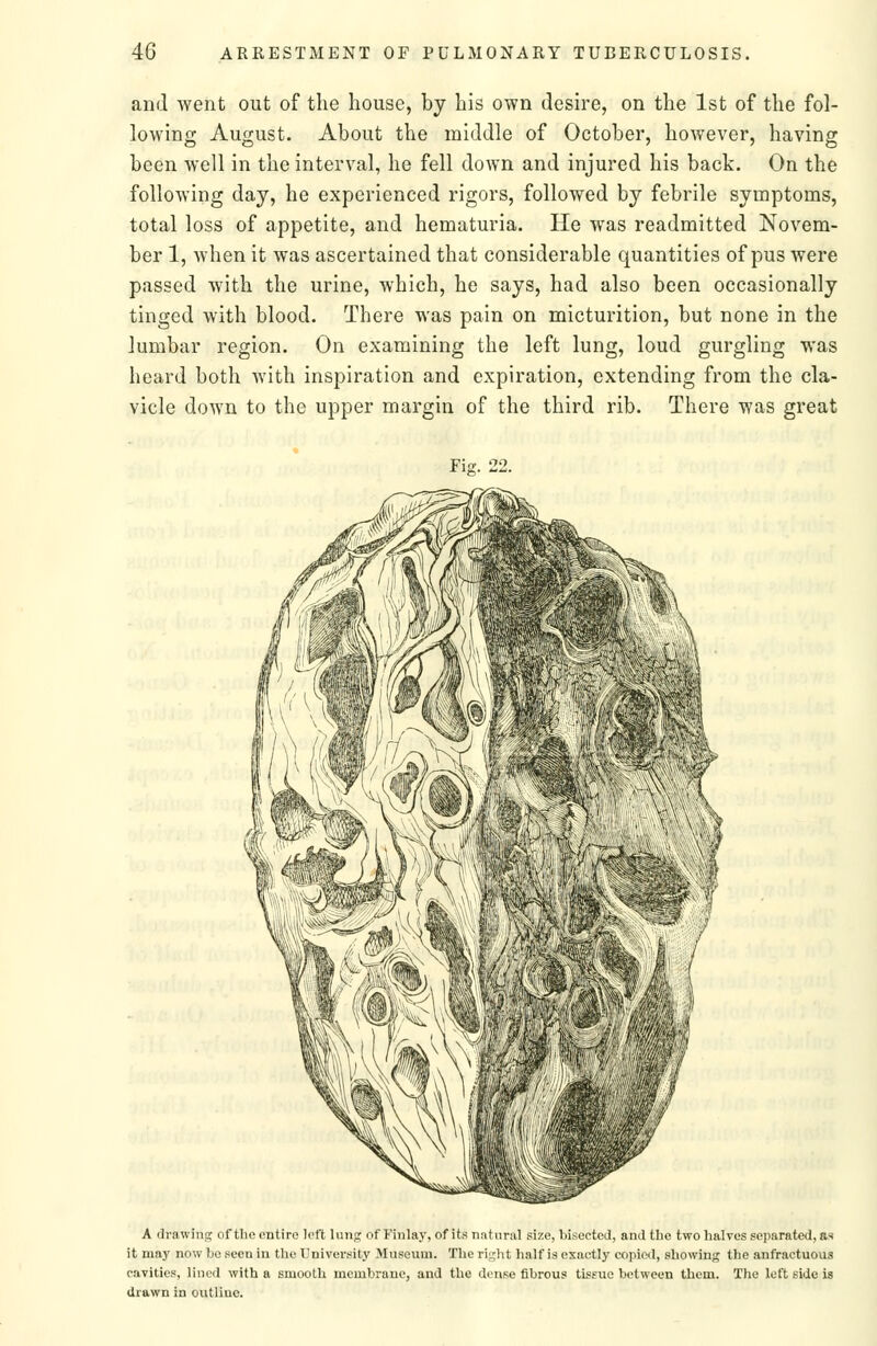 and went out of the house, by his own desire, on the 1st of the fol- lowing August. About the middle of October, however, having been well in the interval, he fell down and injured his back. On the following day, he experienced rigors, followed by febrile symptoms, total loss of appetite, and hematuria. He was readmitted Novem- ber 1, when it was ascertained that considerable quantities of pus were passed with the urine, which, he says, had also been occasionally tinged with blood. There was pain on micturition, but none in the lumbar region. On examining the left lung, loud gurgling was heard both with inspiration and expiration, extending from the cla- vicle down to the upper margin of the third rib. There was great Fig. 22. A drawing of tlio entire loft lung of Finlay, of its niitural size, Ijisoctcd, and the two halves separated, as it may now be seen in the University Museum. The right half is exactly copied, showing the anfractuous cavities, lined with a smooth membrane, and the douse fibrous tiseue between them. The left side is drawn in outline.