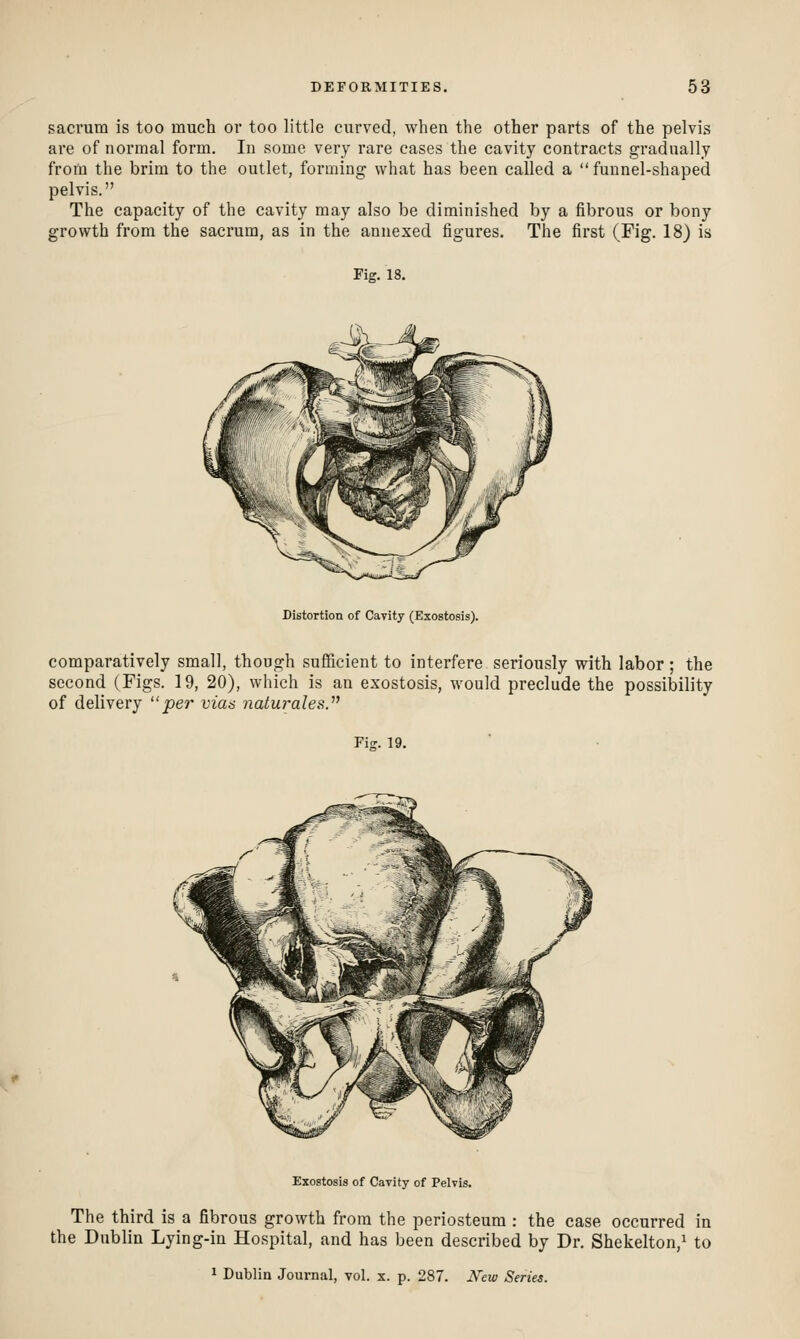 sacrum is too much or too little curved, when the other parts of the pelvis are of normal form. In some very rare cases the cavity contracts gradually froiii the brim to the outlet, forming what has been called a funnel-shaped pelvis. The capacity of the cavity may also be diminished by a fibrous or bony growth from the sacrum, as in the annexed figures. The first (Fig. 18) is Fi-. 18. Distortion of Cavity (Exostosis). comparatively small, though sufficient to interfere seriously with labor ; the second (Figs. 19, 20), which is an exostosis, would preclude the possibility of delivery per vias naturales.^' Fis. 19. Exostosis of Cavity of Pelvis. The third is a fibrous growth from the periosteum : the case occurred in the Dublin Lying-in Hospital, and has been described by Dr. Shekelton,i to 1 Dublin Journal, vol. x. p. 287. Wcw Series.