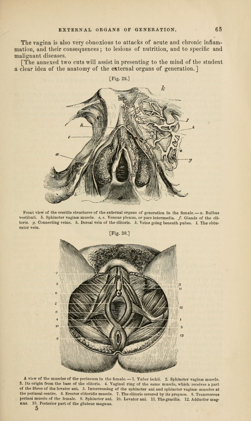 The vagina is also very obnoxious to attacks of acute and chronic infiam- mation, and their consequences; to lesions of nutrition, and to specific and malignant diseases. [The annexed two cuts will assist in presenting to the mind of the student a clear idea of the anatomy of the external organs of generation.] [Fig. 29.] Front view of the erectile structures of the external organs of generation in the female. — a. Bulbus vestibuli. h. Sphincter vaginae muscle. «, e. Venous plexus, or pars intermedia. /. Glands of the cli- toris, g. Connecting veins, h. Dorsal vein of the clitoris, k. Veins going beneath pubes. I. The obtu- rator vein. [Fig. 30.] A view of the muscles of the perineum in the female. — 1. Tuber i.ichii. 2. Sphincter vaginse muscle. 3. Its origin from the base of the clitoris. 4. Vaginal ring of the same muscle, which receives a part of the fibres of the levator ani. 5. Intercrossing of the sphincter ani and sphincter vaginae mu.scles at the perineal centre. 6. Erector clitoridis muscle. 7. The clitoris covered by its prepuce. 8. Transversus perinei muscle of the female. 9. Sphincter ani. 10. Levator ani. 11. The gracilis. 12. Adductor mag- nus. 13. Posterior part of the gluteus magnus. 5