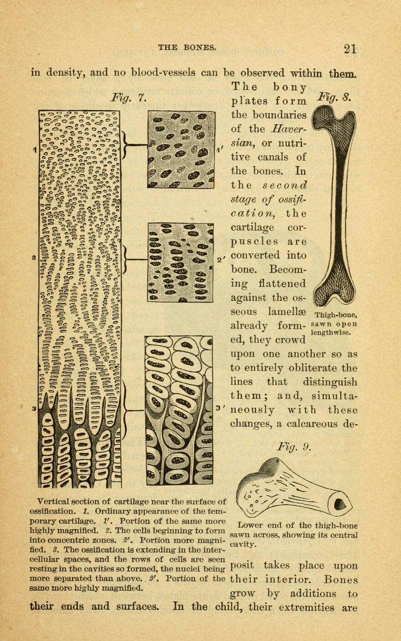 Fig. 7. Fig. 8. •s^.^of.o: ,--o 1. V-°1 f a &A ■5 <^ 3*5 ■Jv ^# ^g Ifl^i h a. » ^ ^ ^ <=• ♦ *£^ ^^ in density, and no blood-vessels can be observed within them. The bony plates form the boundaries of the Haver- sian, or nutri- tive canals of the bones. In the s econd stage of ossifi- cation, the cartilage cor- puscles are 2/ converted into bone. Becom- ing flattened against the os- seous lamellae Thigh-bone, already form- ^^^ p^ '' lengthwise. ed, they crowd upon one another so as to entirely obliterate the lines that distinguish them; and, simulta- 3' neously with these changes, a calcareous de- Fig. 9. Vertical section of cartilage near the sui-face of ossification. 1. Ordinary appearance of the tem- porary cartilage. 1'. Portion of the same more highly magnified. 2. The cells beginning to form into concentric zones. 2'. Portion more magni- fied. S. The ossification is extending in the inter- cellular spaces, and the rows of cells are seen resting in the cavities so formed, the nuclei being more separated than above, same more highly magnified. Lower end of the thigh-bone sa^vn across, showing its central cavity. place upon posit takes Portion of the their interior. Bones grow by additions to their ends and surfaces. In the child, their extremities are