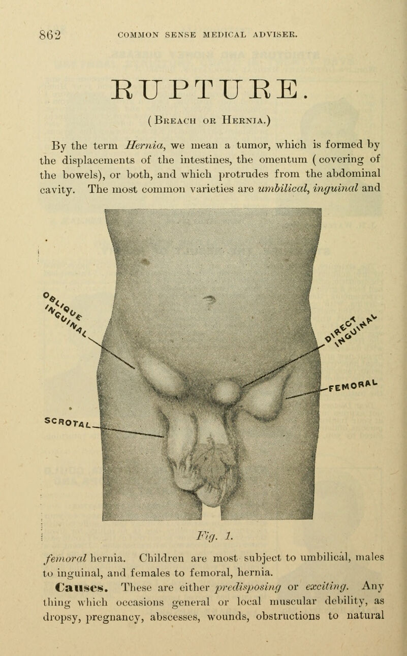 EUPTURE. ( Breach or Hernia.) By the term Hernia, we mean a tumor, which is formed by the displacements of the intestines, the omentum (covering of the bowels), or both, and which protrudes from the abdominal cavity. The most common varieties are umbilical^ inguinal and X. SCROTAL \ Fig. 1. femoral hernia. Children are most subject to umbilical, males to inguinal, and females to femoral, hernia. Cail!>«e»!$. These are either predisposing or exciting. Any thing which occasions general or local muscular debility, as dropsy, pregnancy, abscesses, wounds, obstructions to natural