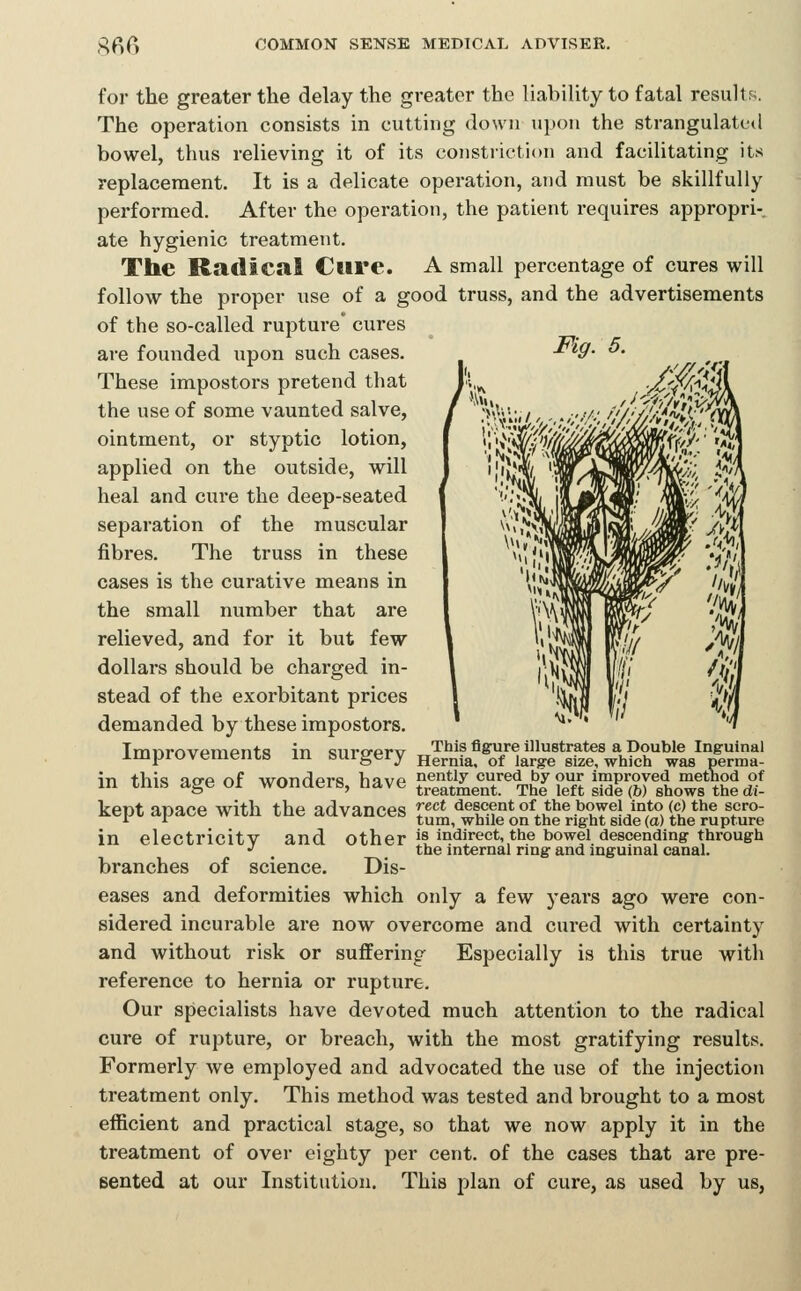 for the greater the delay the greater the liability to fatal results. The operation consists in cutting down upon the strangulated bowel, thus relieving it of its constriction and facilitating its replacement. It is a delicate operation, and must be skillfully performed. After the operation, the patient requires appropri- ate hygienic treatment. The Radical Cure. A small percentage of cures will follow the proper use of a good truss, and the advertisements of the so-called rupture* cures are founded upon such cases. These impostors pretend that the use of some vaunted salve, ointment, or styptic lotion, applied on the outside, will heal and cure the deep-seated separation of the muscular fibres. The truss in these cases is the curative means in the small number that are relieved, and for it but few dollars should be charged in- stead of the exorbitant prices demanded by these impostors. Tmnrrvvpnipnts in Qiiro-prxr This figure illustrates a Double Inguinal improvements in SUlgery Hernia, of large size, which was perma- in tlii« qo-p nf -wnnriprs hnvp nently cured by our improved metnod of in tnis age or WOnaers, nave treatment. The left side (b) shows the di- kept apace with the advances T^* descent of the bowel into (c) the scro- i i turn, while on the right side (a) the rupture in electricitV and other is iJ^'^irect, the bowel descending through •' , the internal ring and inguinal canal, branches of science. Dis- eases and deformities which only a few years ago were con- sidered incurable are now overcome and cured with certainty and without risk or suffering Especially is this true with reference to hernia or rupture. Our specialists have devoted much attention to the radical cure of rupture, or breach, with the most gratifying results. Formerly we employed and advocated the use of the injection treatment only. This method was tested and brought to a most efficient and practical stage, so that we now apply it in the treatment of over eighty per cent, of the cases that are pre- sented at our Institution. This plan of cure, as used by us.