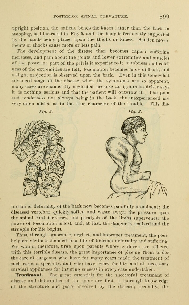 upright position, tiiy patient bends tlie linees ratlier tiian tlie back in stooping, as illustrated in Fig. 5, and the body is frequently supported by the hands being placed upon the thighs or knees. Sudden move- ments or shocks cause more or less pain. The development of the disease then becomes rapid; sufterino- increases, and pain about the joints and lower extremities and muscles of the posterior part of the pelvis is experienced; numbness and cold- ness of the extremities are felt; locomotion becomes more difficult, and a slight projection is observed upon the back. Even in this somewhat advanced stage of the disease, when the symptoms are so apparent, many cases are shamefully neglected because an ignorant adviser says it is nothing serious and that the patient will outgrow it. The pain and tenderness not always being in the back, the inexperienced are very often misled as to the true character of the trouble. This dis- Fig. Fig. 3. tortion or deformity of the back now becomes painfully prominent; the diseased vertebrae quickly soften and waste away; the pressure upon the spinal cord increases, and paralysis of the limbs supervenes; the power of locomotion is lost, and, at last, the danger is realized and the straggle for life begins. Thus, through ignorance, neglect, and improper treatment, the poor, helpless victim is doomed to a life of hideous deformity and suffering. We would, therefore, urge upon parents whose children are afflicted with this terrible disease, the great importance of placing them under, the care of surgeons who have for many years made the treatment of such cases a specialty, and who have every facility and all necessary surgical appliances for insuring success in every case undertaken. Treatment. The great essentials for the successful treatment of disease and deformities of the spine are fh'st, a thorough knowledge of the structure and parts involved bj^ the disease; secondly, the