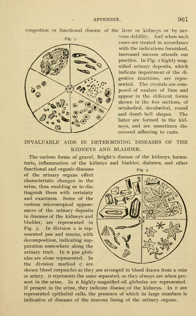 congestion or functional disease of the liver or kidnejs or by ner- p. vous debility. And when such cases are treated in accordance with the indications furnished, increased success attends our practice. In Fig. 2 highly mag- nified urinary deposits, which indicate impairment of the di- gestive functions, are repre- sented. The crystals are com- posed of oxalate of lime and appear in the different forms shown in the five sections, of octahedral, decahedral, round and dumb bell shapes. The latter are formed in the kid- neys, and are sometimes dis- covered adhering to casts. INVALUABLE AIDS IN DETERMINING DISEASES OF THE KIDNEYS AND BLADDER. The various forms of gravel, Bright's disease of the kidneys, haema- turia, inflammation of the kidneys and bladder, diabetes, and other functional and organic diseases of the urinary organs effect characteristic changes in the urine, thus enabling us to dis- tinguish them with certainty and exactness. Some of the various microscopical appear- ances of the urinary deposits in diseases of the kidneys and bladder, are represented in Fig. 3. In division a is rep- resented pus and mucus, with decomposition, indicating sup- puration somewhere along the urinary tract. In B pus glob- ules are alone represented. In the division marked c are shown blood corpuscles as they are arranged in blood drawn from a vein or artery, d represents the rame separated, as they always are when pre- sent in the urine. In E highly magnified oil globules are represented. If present in the urine, they indicate disease of the kidneys. In F are represented epithelial cells, the presence of which in large numbers is indicative of diseases of the mucous lining of the urinary organs.