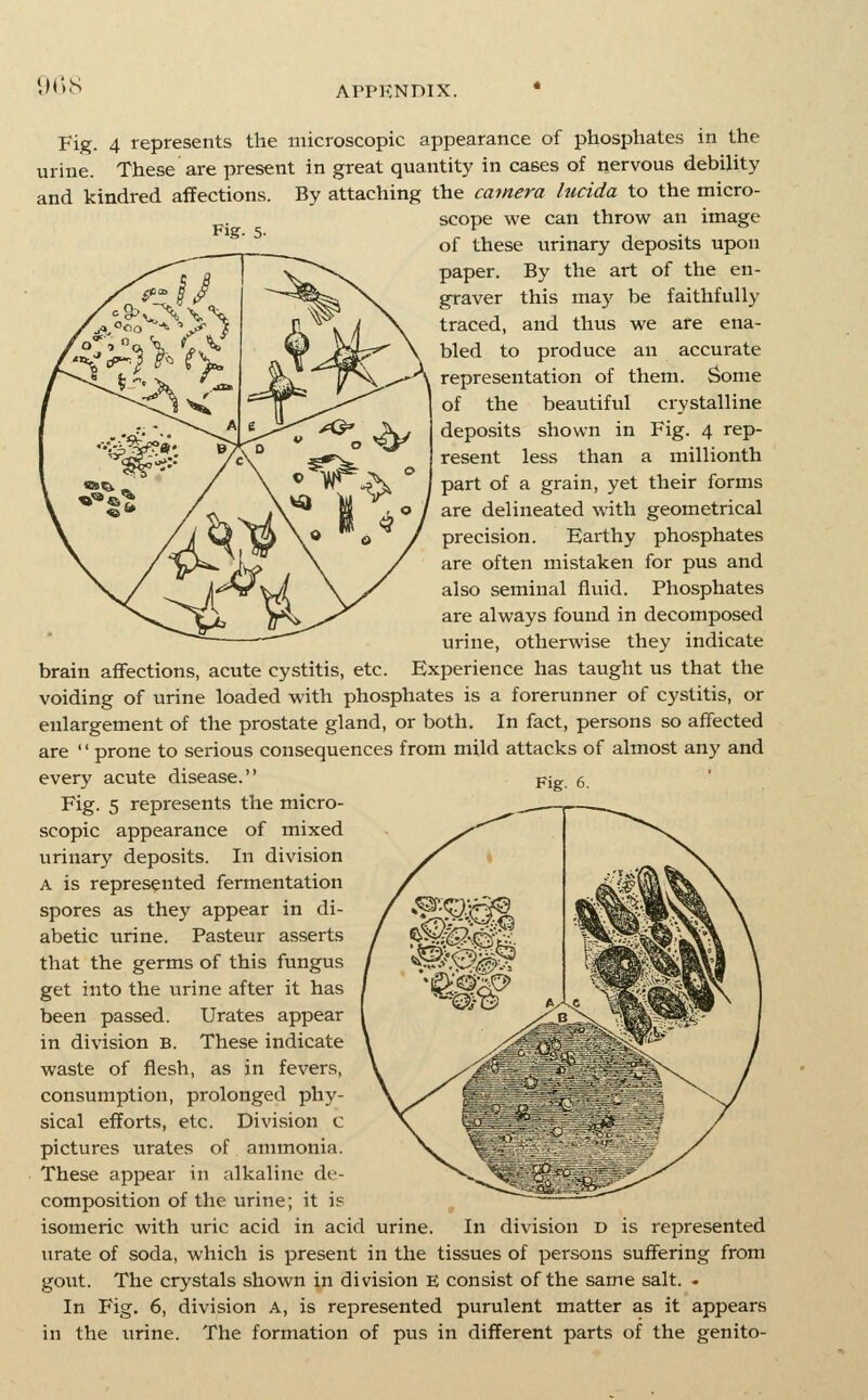 •KuS Fig. 5. Fig. 4 represents the microscopic appearance of phosphates in the urine. These are present in great quantity in cases of nervous debility and kindred affections. By attaching the camera lucida to the micro- scope we can throw an image of these urinary deposits upon paper. By the art of the en- graver this ma)' be faithfully traced, and thus we are ena- bled to produce an accurate representation of them. Some of the beautiful crystalline deposits shown in Fig. 4 rep- resent less than a millionth part of a grain, yet their forms are delineated with geometrical precision. Earthy phosphates are often mistaken for pus and also seminal flviid. Phosphates are always found in decomposed urine, otherwise they indicate brain aflFections, acute cystitis, etc. Experience has taught us that the voiding of urine loaded with phosphates is a forerunner of cystitis, or enlargement of the prostate gland, or both. In fact, persons so affected are '' prone to serious consequences from mild attacks of almost any and every acute disease. Fig. 5 represents the micro- scopic appearance of mixed urinary deposits. In division A is represented fermentation spores as they appear in di- abetic urine. Pasteur asserts that the germs of this fungus get into the urine after it has been passed. Urates appear in division B. These indicate waste of flesh, as in fevers, consumption, prolonged phy- sical efforts, etc. Division c pictures urates of ammonia. These appear in alkaline de- composition of the urine; it is isomeric with uric acid in acid urine. In division d is represented urate of soda, which is present in the tissues of persons suffering from gout. The crystals shown in division E consist of the same salt. - In Fig. 6, division A, is represented purulent matter as it appears in the urine. The formation of pus in different parts of the genito-