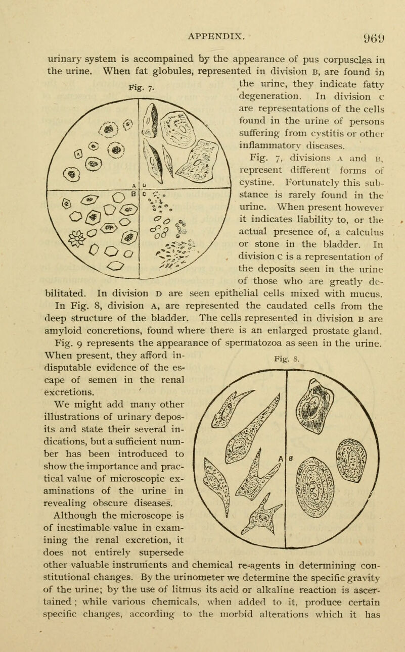 961) urinary system is accompained by the appearance of pus corpuscles in the urine. When fat globules, represented in division b, are found in pj y_ the urine, they indicate fatty degeneration. In division c are representations of the cells found in the urine of persons suffering from cystitis or othtr inflammatory diseases. Fig. 7, divisions a and n, represent different forms of cystine. Fortunately this sub- stance is rarely found in the urine. When present however it indicates liability to, or the actual presence of, a calculus or stone in the bladder. In division c is a representation of the deposits seen in the urine of those who are greatly de- bilitated. In division D are seen epithelial cells mixed with mucus. In Fig. 8, division A, are represented the caudated cells from the deep structure of the bladder. The cells represented in division b are amyloid concretions, found where there is an enlarged prostate gland. Fig. 9 represents the appearance of spermatozoa as seen in the urine. When present, they afford in- disputable evidence of the es- cape of semen in the renal excretions. We might add many other illustrations of urinary depos- its and state their several in- dications, but a sufficient num- ber has been introduced to show the importance and prac- tical value of microscopic ex- aminations of the urine in revealing obscure diseases. Although the microscope is of inestimable value in exam- ining the renal excretion, it does not entirely supersede other valuable instruments and chemical re-agents in determining con- stitutional changes. By the urinometer we determine the specific gravity of the urine; by the use of litmus its acid or alkaline reaction is ascer- tained ; while various chemicals, when added to it, produce certain specific changes, according to the morbid alterations which it has Fig. 8.