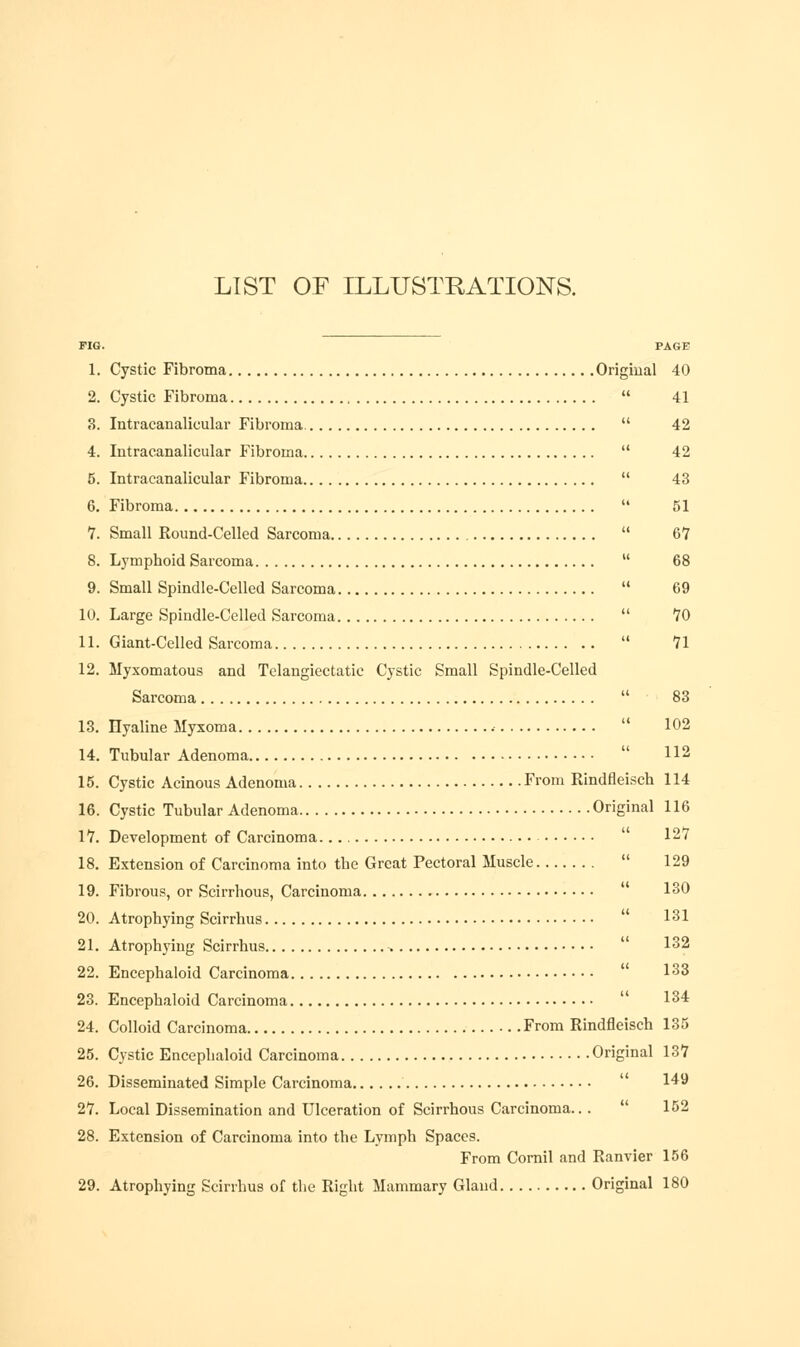 LIST OF ILLUSTRATIONS. FIG. PAGE 1. Cystic Fibroma Origiual 40 2. Cystic Fibroma  41 3. Intracanalicular Fibroma.  42 4. Intracanalicular Fibroma  42 5. Intracanalicular Fibroma  43 6. Fibroma  51 1. Small Round-Celled Sarcoma  67 8. Lymphoid Sarcoma  68 9. Small Spindle-Celled Sarcoma  69 10. Large Spindle-Celled Sarcoma  70 11. Giant-Celled Sarcoma  71 12. Myxomatous and Telangiectatic Cystic Small Spindle-Celled Sarcoma  83 13. Hyaline Myxoma  102 14. Tubular Adenoma  112 15. Cystic Acinous Adenoma From Rindfleisch 114 16. Cystic Tubular Adenoma Original 116 17. Development of Carcinoma  127 18. Extension of Carcinoma into the Great Pectoral Muscle  129 19. Fibrous, or Scirrhous, Carcinoma  130 20. Atrophying Scirrhus  131 21. Atrophying Scirrhus  132 22. Encephaloid Carcinoma  133 23. Encephaloid Carcinoma  134 24. Colloid Carcinoma From Rindfleisch 135 25. Cystic Encephaloid Carcinoma Original 137 26. Disseminated Simple Carcinoma  1^9 27. Local Dissemination and Ulceration of Scirrhous Carcinoma...  152 28. Extension of Carcinoma into the Lymph Spaces. From Cornil and Ranvier 156 29. Atrophying Scirrhus of the Right Mammary Gland Original 180