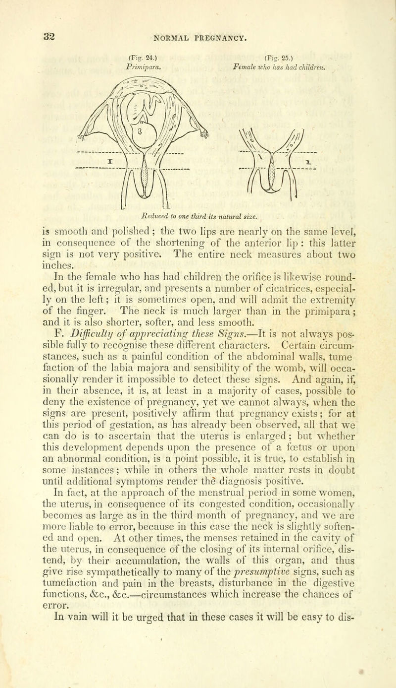 (Fig. 24.) Primipara. (Fi-. 25.) Female who has had children. Reduced to one third its natural size. is smooth and polished ; the two lips are nearly on the same level, in consequence of the shortening of the anterior lip : this latter sign is not very positive. The entire neck measures about two inches. In the female who has had children the orifice is likewise round- ed, but it is irregular, and presents a number of cicatrices, especial- ly on the left; it is sometimes open, and will admit the extremity of the finger. The neck is much larger than in the primipara; and it is also shorter, softer, and less smooth. F. Difficulty of appreciating these Signs.—It is not always pos- sible fully to recognise these different characters. Certain circum- stances, such as a painful condition of the abdominal walls, tume faction of the labia majora and sensibility of the womb, will occa- sionally render it impossible to detect these signs. And again, if, in their absence, it is, at least in a majority of cases, possible to deny the existence of pregnancy, yet we cannot always, when the signs are present, positively affirm that pregnancy exists; for at this period of gestation, as has already been observed, all that we can do is to ascertain that the uterus is enlarged; but whether this development depends upon the presence of a foetus or upon an abnormal condition, is a point possible, it is true, to establish in some instances; while in others the whole matter rests in doubt until additional symptoms render the diagnosis positive. In fact, at the approach of the menstrual period in some women, the uterus, in consequence of its congested condition, occasionally becomes as large as in the third month of pregnancy, and we are more liable to error, because in this case the neck is slightly soften- ed and open. At other times, the menses retained in the cavity of the uterus, in consequence of the closing of its internal orifice, dis- tend, by their accumulation, the walls of this organ, and thus give rise sympathetically to many of the presumptive signs, such as tumefaction and pain in the breasts, disturbance in the digestive functions, &c., &c.—circumstances which increase the chances of error. In vain will it be urged that in these cases it will be easy to dis-