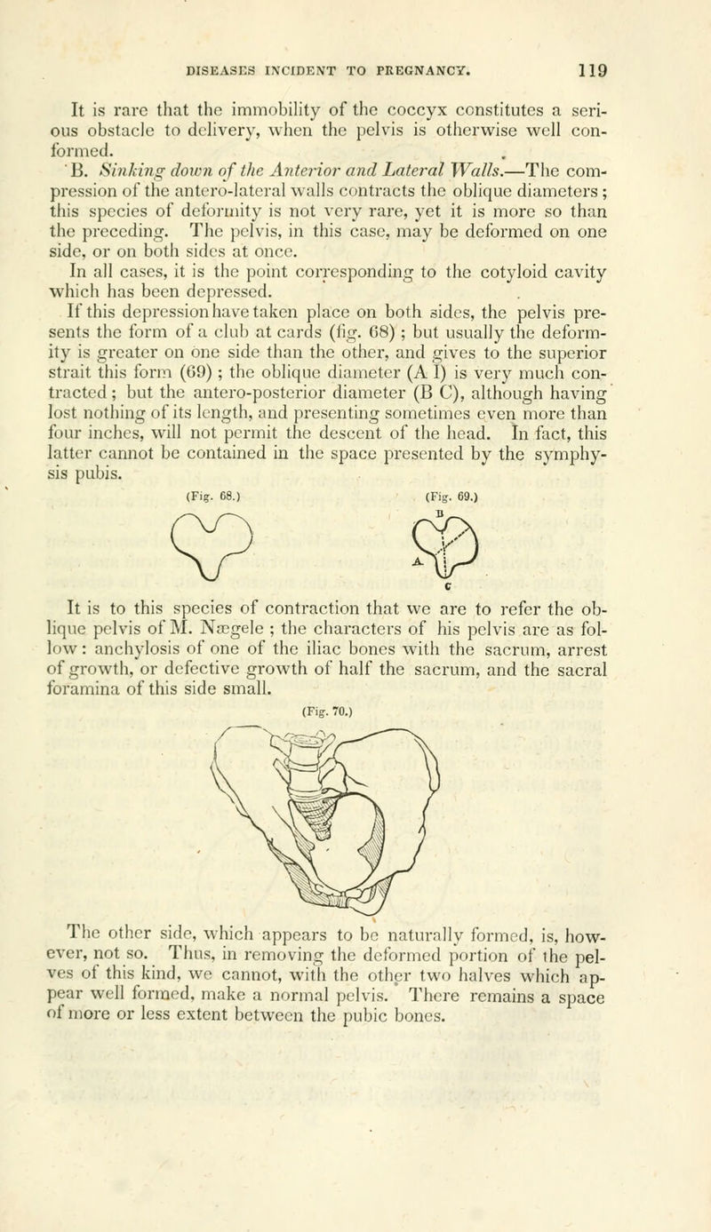 It is rare that the immobility of the coccyx constitutes a seri- ous obstacle to delivery, when the pelvis is otherwise well con- formed. ■ B. Sinki7ig down of the Antejnor and Lateral Walls.—The com- pression of the antero-latcral walls contracts the oblique diameters; this species of deformity is not very rare, yet it is more so than the preceding. The pelvis, in this case, may be deformed on one side, or on both sides at once. In all cases, it is the point corresponding to the cotyloid cavity which has been depressed. If this depression have taken place on both sides, the pelvis pre- sents the form of a club at cards (fig. 68); but usually the deform- ity is greater on one side than the other, and gives to the superior strait this form (69); the oblique diameter (A I) is very much con- tracted; but the antero-posterior diameter (B C), although having lost nothing of its length, and presenting sometimes even more than four inches, will not permit the descent of the head. In fact, this latter cannot be contained in the space presented by the symphy- sis pubis. (Fig. 68.) ^ It is to this species of contraction that we are to refer the ob- lique pelvis of M. Na3gele ; the characters of his pelvis are as fol- low : anchylosis of one of the iliac bones with the sacrum, arrest of growth, or defective growth of half the sacrum, and the sacral foramina of this side small. (Fig. 70.) The other side, which appears to be naturally formed, is, how- ever, not so. Thus, in removing the deformed portion of the pel- ves of this kind, we cannot, with the other two halves which ap- pear well formed, make a normal pelvis. There remains a space of more or less extent between the pubic bones.