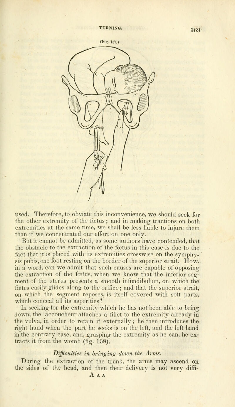 used. Therefore, to obviate this inconvenience, we should seek for the other extremity of the foetus; and in making tractions on both extremities at the same time, we shall be less hable to injure them than if we concentrated our effort on one only. But it cannot be admitted, as some authors have contended, that the obstacle to the extraction of the foetus in this case is due to the fact that it is placed with its extremities crosswise on the symphy-' sis pubis, one foot resting on the border of the superior strait. How, in a word, can we admit that such causes are capable of opposing the extraction of the fojtus, when we know that the inferior seg- ment of the uterus presents a smooth infundibulum, on which the foetus easily glides along to the orifice; and that the superior strait, on which the segment reposes, is itself covered with soft parts, which conceal all its asperities? In seeking for the extremity which he has not been able to bring down, the accoucheur attaches a fillet to the extremity already in the vulva, in order to retain it externally; he then introduces the right hand when the part he seeks is on the left, and the left hand in the contrary case, and, grasping the extremity as he can, he ex- tracts it from the womb (fig. 158). Difficulties in bringing down the Arms. During the extraction of the trunk, the arms may ascend on the sides of the head, and then their delivery is not very diffi- A A A