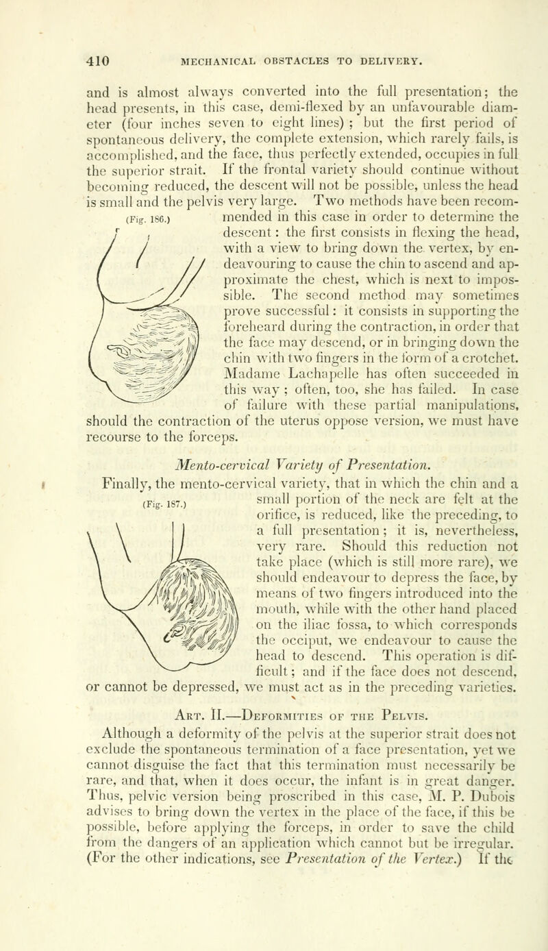 (Fig. 186.) and is almost always converted into the full presentation; the head presents, in this case, demi-llexed by an unfavourable diam- eter (four inches seven to eight lines) ; but the first period of spontaneous delivery, the complete extension, which rarely fails, is accomplished, and the face, thus perfectly extended, occupies in full the superior strait. If the frontal variety should continue without becoming reduced, the descent will not be possible, unless the head is small and the pelvis very large. Two methods have been recom- mended in this case in order to determine the descent: the first consists in flexing the head, with a view to bring down the vertex, by en- deavouring to cause the chin to ascend and ap- proximate the chest, which is next to impos- sible. The second method may sometimes prove successful: it consists in supporting the foreheard during the contraction, in order that the face may descend, or in bringing down the chin with two fingers in the form of a ci'otchet. Madame Lachapelle has often succeeded in this way ; often, too, she has failed. In case of failure with these partial manipulations, should the contraction of the uterus oppose version, w^e must have recourse to the forceps. Mento-cervical Variety of Presentation. Finally, the mento-cervical variety, that in which the chin and a small portion of the neck are felt at the orifice, is reduced, like the preceding, to a full presentation; it is, nevertheless, very rare. Should this reduction not take place (which is still more rare), w^e should endeavour to depress the face, by means of two fingers introduced into the mouth, while with the other hand placed on the iliac fossa, to which corresponds the occiput, we endeavour to cause the head to descend. This operation is dif- ficult; and if the face does not descend, or cannot be depressed, we must act as in the preceding varieties. Art. II,—Deformities of the Pelvis. Although a deformity of the pelvis at the superior strait does not exclude the spontaneous termination of a face presentation, yet we cannot disguise the fact that this termination must necessarily be rare, and that, when it does occur, the infant is in great danger. Thus, pelvic version being proscribed in this case, M. P. Dubois advises to bring down the vertex in the place of the face, if this be possible, before applying the forceps, in order to save the child from the dangers of an application which cannot but be irregular. (For the other indications, see Presentation of the Vertex.) If tlic