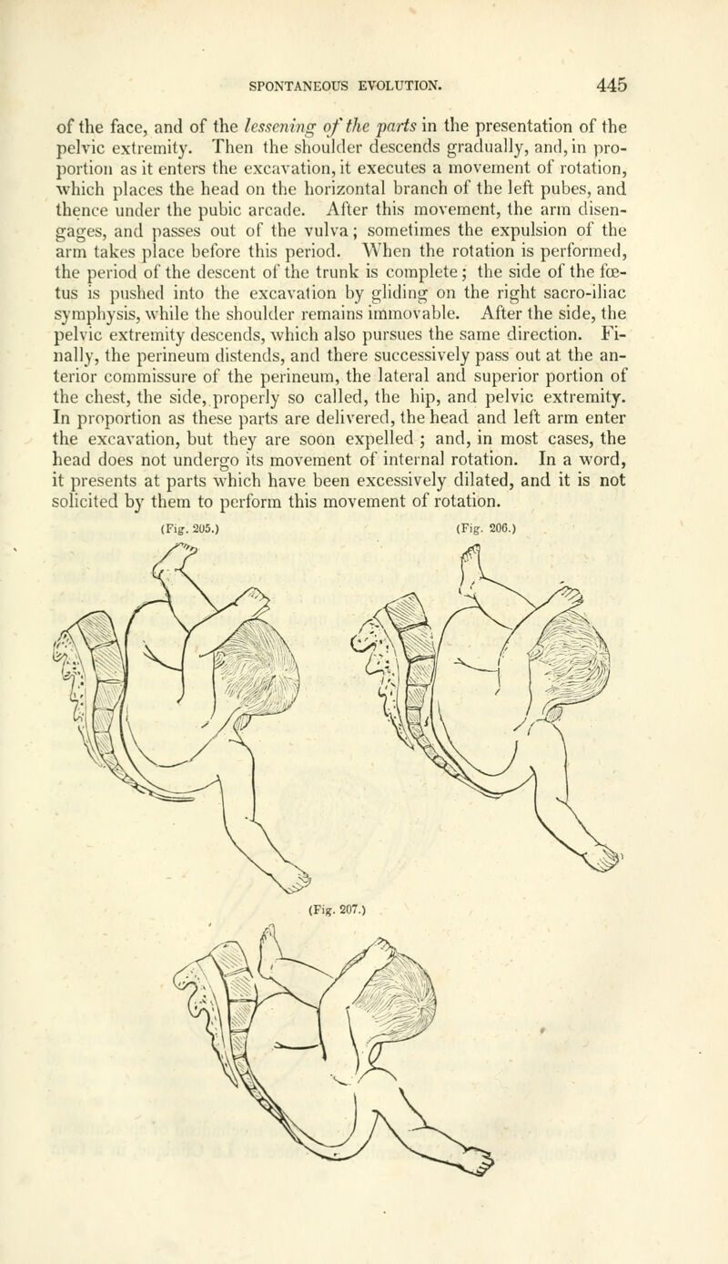 of the face, and of the lessening of the parts in the presentation of the pelvic extremity. Then the shoulder descends gradually, and, in pro- portion as it enters the excavation, it executes a movement of rotation, which places the head on the horizontal branch of the left pubes, and thence under the pubic arcade. After this movement, the arm disen- gages, and passes out of the vulva; sometimes the expulsion of the arm takes place before this period. When the rotation is performed, the period of the descent of the trunk is complete; the side of the foe- tus is pushed into the excavation by gliding on the right sacro-iliac symphysis, while the shoulder remains immovable. After the side, the pelvic extremity descends, which also pursues the same direction. Fi- nally, the perineum distends, and there successively pass out at the an- terior commissure of the perineum, the lateral and superior portion of the chest, the side, properly so called, the hip, and pelvic extremity. In proportion as these parts are delivered, the head and left arm enter the excavation, but they are soon expelled ; and, in most cases, the head does not undergo its movement of internal rotation. In a word, it presents at parts which have been excessively dilated, and it is not solicited by them to perform this movement of rotation. (Fig. 205.) (Fig. 206.) (Fig. 207.)