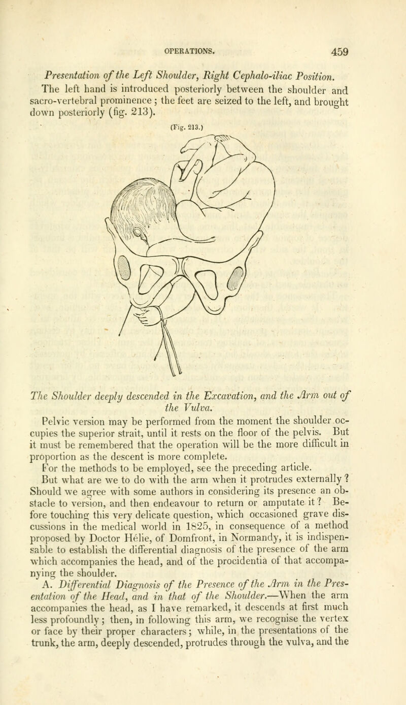 Presentation of the Left Shoulder, Right Cephalo-iliac Position. The left hand is introduced posteriorly between the shoulder and sacro-vertebral prominence ; the feet are seized to the left, and brouo-ht down posteriorly (fig. 213). (Fig. 213.) The Shoulder deeply descended in the Excavation, and the Arm out of the Vulva. Pelvic version may be performed from the moment the shoulder oc- cupies the superior strait, until it rests on the floor of the pelvis. But it mu.st be remembered that the operation will be the more difficult in proportion as the descent is more complete. For the methods to be employed, see the preceding article. But what are we to do with the arm when it protrudes externally 1 Should we agree with some authors in considering its presence an ob- stacle to version, and then endeavour to return or amputate it? Be- fore touching this very delicate question, which occasioned grave dis- cussions in the medical world in 1825, in consequence of a method proposed by Doctor Helie, of Domfront, in Normandy, it is indispen- sable to establish the differential diagnosis of the presence of the arm which accompanies the head, and of the procidentia of that accompa- nying the shoulder. A. Differential Diagnosis of the Presence of the Arm in the Pres- entation of the Head, and in that of the Shoulder.—When the arm accompanies the head, as I have remarked, it descends at first much less profoundly; then, in following this arm, we recognise the vertex or face by their proper characters; while, in the presentations of the trunk, the arm, deeply descended, protrudes through the vulva, and the