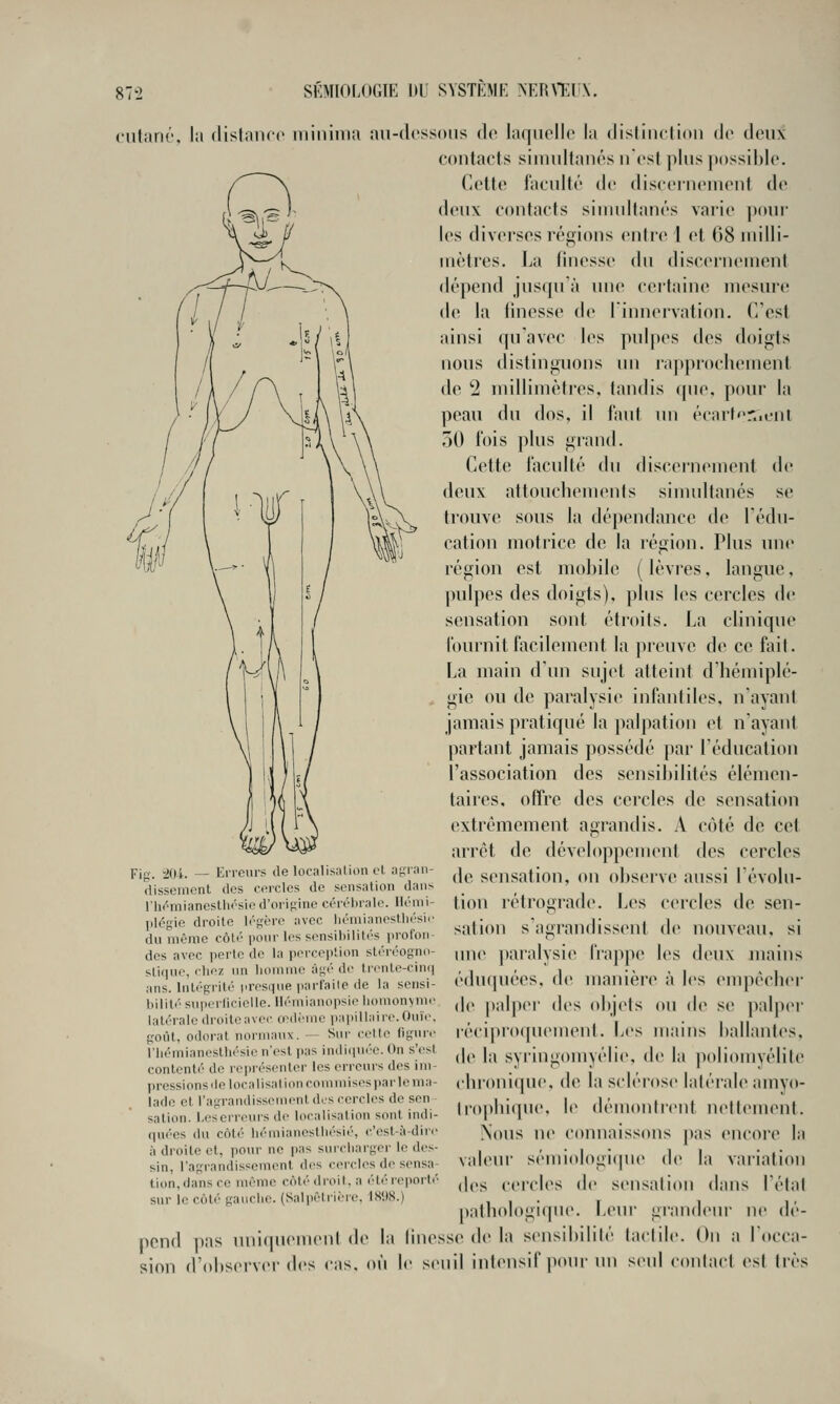 ■Kr» ciitarK', lit (lislnitcc mininia au-dessous do laquelle la dislinction de deux contacts simultanés n'est plus possible. Cette faculté de discernement de deux contacts simultanés varie poul- ies diverses régions entre 1 et 68 milli- mètres. La finesse du discernement dépend juscpi'à une certaine nu\sur(! de la linesse de linnervation. C'est ainsi rpiavec les pulpes des doigts nous distinguons un i'a])prochement de 2 millimètres, tandis <pie, pour la peau du dos, il faut un écart'T.ienl 50 fois plus grand. Cette lacullé du discernement de deux attouchements simultanés se trouve sous la dépendance de Tédu- cation motrice de la région. Plus ime région est mobile ( lèvres, langue, pulpes des doigts), plus les cercles de sensation sont étroits. La clinique fournit facilement la pieuvc de ce fait. La main d'un sujet atteint d'hémiplé- gie ou de paralysie infantiles, n'ayant jamais pratiqué la palpation et nayant partant jamais possédé par l'éducation l'association des sensibilités élémen- taires, offre des cercles de sensation extrêmement agrandis. A côté de cet arrêt de développement des cercles de sensation, on observe aussi l'évolu- tion rétrograde. Les cercles de sen- sation s'agrandissent de nouveau, si ime ])aralysie l'ra])pe les deux mains éduquées, de manière à les (Mupècber de |)alper des objets ou de se palper réci|)ro(puMnent. Les mains ballantes, de la syringomyélie, de la poliomyélite (•lu'onicjue, de la sclérose latérale amyo- lroi)hi(pie. le démonticnt nettement. Nous ne connaissons pas encore la valeur sémiologicpie de la variation des ceirles de sensation dans l'état pathologique. Leui' grandeur ne dé- pend pas uniquement de la linesse de la sensibilité tactil»'. Ou a Locca- sion d'fdiservei- des cas. où le seuil intensif pour un seul contact est très Fi-. 201. — Erreurs de localisnlion cl yt;ran- dissement des cercles de sensalioii dans riif^mianesUiésie d'oripino ci'rélirale. \U'-nu- plégie droite légère avec liéiiiianeslliésir du même côté t'O''l**^'^^'^'''''^ profon des avec perte de la i)erce|)tion stéréogim- sli(iue, clioz un liomme àgt''de IrciUc^-ciiui ans. Intégrité iiresque parlaite de la sensi- bilité superlicielle. Ilémianopsie lionionviin' latérale droiteaver œdème papillairo.OniV. goût, odorat normaux. -— Sni- celle ligiirc l'iiémianesthésie n'est pas indicinée. On s'csl contenté de représenter les erreurs des im- pressions île localisai ion commises par le ma- lade et l'agrandissement des cercles de sen sation. Les erreurs de localisation sont indi- quées du côté hémianeslliésié, c'est-à-dire à droite et, pour ne pas surcharger le des- sin, l'agrandissement des cercl(>s de sensa- tion,dans ce uu'me côlédi-eil. a <'-tércport(' sur le coté gauche. (Salpètrière, ISilS.)