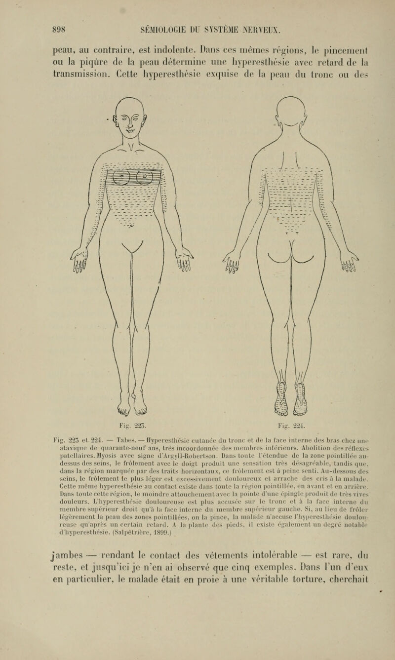 peau, au contrairo, est indolente. Dans ces niènu's régions, le jtincemenl ou la piqûre de la peau détermine une hyperesHiésie avec retard de la transmission. Cette hyperestliésie exquise de la peau du tronc ou des Fi. Fi^ Fig. 223 et 221. — Tiihcs. — Hyperoslhc'siii cutanée du lioiic cl de la l'ace interne des bi-as chez uni' ataxiquc de fiuaranlc-neut'ans, très incoordonnée dos nuMubres inlériours. Abolition des réflexes patellaires. Myosis avec signe d'Argyll-Robertson. Dans toute l'étendue de la zone pointillée au- dessus des seins, le frôlement avec le doigt produit une sensation très désagréable, tandis que. dans la région marquée par des traits horizontaux, ce l'roleuient est à peine senti. Au-dessous des seins, le l'rôlement le plus léger est excessivement douloureux et arrache des cris à la malade. Celte même hypercslhésie au contact existe dans toute la région polnlilb'e, en avant (;t en arrière. Dans toute celte région, le moindre attoucliemenlavec la pointe d'une épingle |irodiiit de ti'èsviv<»s douleurs. L'hyperestlié.sie douloureusi; est plus a(H-us('t> sur le tronc et à la lace interne du membre supérieur dioit qu'à la lace interne du membre supé-rieiu- gauche. Si, au lieu de frôler légèrement la peau des zones pointillées. on la pince, la malade n'accuse l'Iiyperesthésie doulou- reuse qu'après >m certain retard. A la )ilanle des pit.-ds. il existe également un degré notable d'iiypercsthésie. (Salpètrièi-o, 1890.) jambes — rendant le contact des vètemenis intolérable — est rare, du reste, et jusqu'ici je n'en ai observé que cinq exemples. Dans l'un d'eux en particulier, le malade était en proie à une véritable torture, cherchait