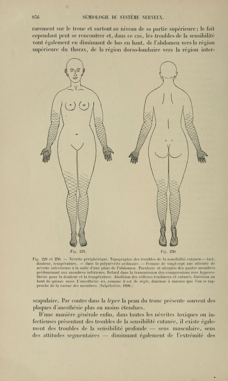 rarement sur le lione et surtout an niveau de sa partie supérieure; le fait cependant peut se reneontrer et, dans ce cas, les ti'ouMesdc la sensibilité vont également en diminuant de bas en haut, de Tabdomen vers la région supérieure du thorax, de la région dorso-lombaire vers la région inter- Fii;. 229. Ki-. 230. Fi{;. 229 et 2ôf). — ISévrite pt-ripliériquo. Topof;ra|)liic des troubles df la sensibilili'(•iiliin<''e—tacl. douleur, leuipiMaturc, — dans la polynévrite ordinaire. — Femme de vinf,ft-sopt ans atteinte de névrite inlectieuse à la suite d'une i)Iaie de l'ahdomen. Paralysie el atrophie des (juatre uiembres piédominant aux meiubres inférieurs. lietard dans la transmission des compressions avec bypeie>- thésie pour la douleur et la température. Abolition des n'tlexes tendin<'ux et culan(''S. Guérison au bout de quinze mois. L'aneslhésie ici. comme il est de rèyle. diminue à mesure que l'on se rap- proche de la racine des membres. (Salpètrit're, 1898.) scapulaire. Pai' contre dans la Icprc la peau du tronc |)iésenl(' souvent des plaques (raneslhésie plus ou moins étendues. D'une manière générale enlin, dans toutes les néviites to.\i(pies ou in- fectieuses présentant des troubles de la sensibilité cutanée, il existe égale- mcmt des troubles de la sensibilité profonde — sens musculaire, sens des attitudes segmenlaires — diminuant égaltMiicnl de rexdémité des