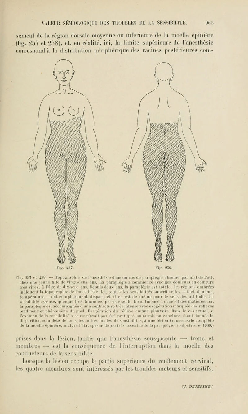 sèment de la région dorsale moyenne ou inférieure de la moelle épinière (lig. 257 et 258), et, en réalité, ici, la limite supérieure de l'anesthésie correspond à la distribution périphérifiue des racines postérieures com- Fig. -257 et -258. — Topoj;rapliie de l'anestliésie dans un cas de j)ai'aplégie absolue par mal de l'ott. chez une jeune fille de vingt-deux ans. La paraplégie a commencé avec des douleurs en ceinture très vives, à l'âge de dix-sept ans. Depuis deux ans, la paraplégie est totale. Les régions ombrées indiquent la topograpiiie de l'anestliésie. Ici, toutes les sensibilités superlicielles — tact, douleur, tem()éralure — ont complètement disparu et il en est de même pour le sens des attitudes. La sensibilité osseuse, quoique très diminuée, persiste seule. Incontinence d'urine et des matières. Ici, la paraplégie est accompagnée d'une contracture très intense avec exagération marquée des réflexes tendineux et piiénomène du pied. Exagération du réflexe cutané plantaire. Dans le cas actuel, si l'examen de la sensibilité osseuse n'avait pas été pratiqué, on aurait pu conclure, étant donnée la disparition complète de tous les autres modes de sensibilités, à une lésion transversale complète de la moelle épinière, malgré l'état spasmodiqiie très accentuéde la para|)l<'gie. (Salpèlrière, 1900.) prises dans la lésion, tandis (pie l'anestliésie sous-jacente — tronc et membres — est la conséquence de riiiterruption dans la moelle des conducteurs de la sensibilité. Lorsque la lésion occupe la partie supérieure du renflement cervical, les quatre membres sont intéressés par les troubles moteurs et sensitifs.