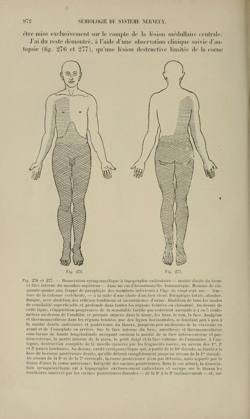 m sK.\iioLO(;iE i)ii SYSTKMI-: .m:i;velx. ôh'c mise cxclusivciiiciit sur !e comitlc de hi Icsiini iiK-diillairc (•<'iili;ilf. .Vai du reste démontré, à l'aide d'une observation eliniqne suivie dan- topsie (fi;^. 276 et 277). (ju'nne lésion desirnclive limitée de la citine l'i;;. -277. l'i;.'. 27('> et 277. — nissoci:itiori syiinf;iiiiiyt'lirnio ;i (o|ui^i:i|il]ii- imlicnlaire — iiioilit' (lroil<! du troiii- ft lace inlcnie du membre supérieur— dan.s un casd'liémalouiy(''lie trauiuali(ju<\ lloniuie de cin- iiuante-(|uatre ans, frappé de parapléfîic des ineinbi-es iiileri<'urs à rài;i' do viniil-si'i'l ans — IVac- hire do la colonne vertébrale, — à la suite d'uni' cliule d'un lieu ('levé', l'aiaplt^'f/ii' totale, absolue. (las(|ue, avec abolition des réilexes tendineux et incontinence d'urine. .Abolition de tous les modes de sensibilité superlicielle et profonde dans toutes les régions teintées en cloisonné', .\u-dessus de cette liî,me, réappai-ition profrressive de la sensibilité tactile qui redevient normale il i ou .i centi- mètres au-de.ssusde l'ombilic et persiste intacte dans le tronc, les bras. le cou, la l'ace. .Analgésie et tliermoanestbésic dans les réfjions teintées par des lifjnes bori/.ontales, se limitant peu à peu à la moitic' droite antérieure et posti'rieure du lliorax, jusipi'un peu :iu-di'ssous de la clavicule en avant et de l'omoplate en arrière. Sur la face interne du bi-as, anestbésie et thermoaneslbé'sie sous forme de bande longitudinale occupant cnvii'on la nuiitié de sa face anti-ro-externe et pos- léro-cxterne, la partie interne de la main, le petit doi^'t et la face externe de l'annulaire. .\ l'an- lopsio, destruction complète de la moelle é'pinièro par les fragments osseux, au niveau des 1. 2' et 3'i)aires lombaires, .\u-dessus, cavité syringomyélitiue qui, à (lartirde la 10* dorsale, se limileà la l>ase de la corne postérieure droite, qu'elle détruit coiuplètement .jusqu'au niveau de la 1 dorsale. Au niveau de la 8 et de la 7* cervicale, la corne posté'iieiire n'est pas détruite, mais sépai'ée par la lésion d'avec la corne antérieure. Inlé},M'ité des racines posté'riem-i^s. Dans le cas actuel, la dissocia- tion syi-iug-omyéliiiue est à topograpliie exclusivement radiculaii'(! l't occupe sui' le lliorn.v les lerritoires innervés jiar les racines i)oslérieurcs dorsales — de la 8* à la 2* inchisivenicnt — et, sur