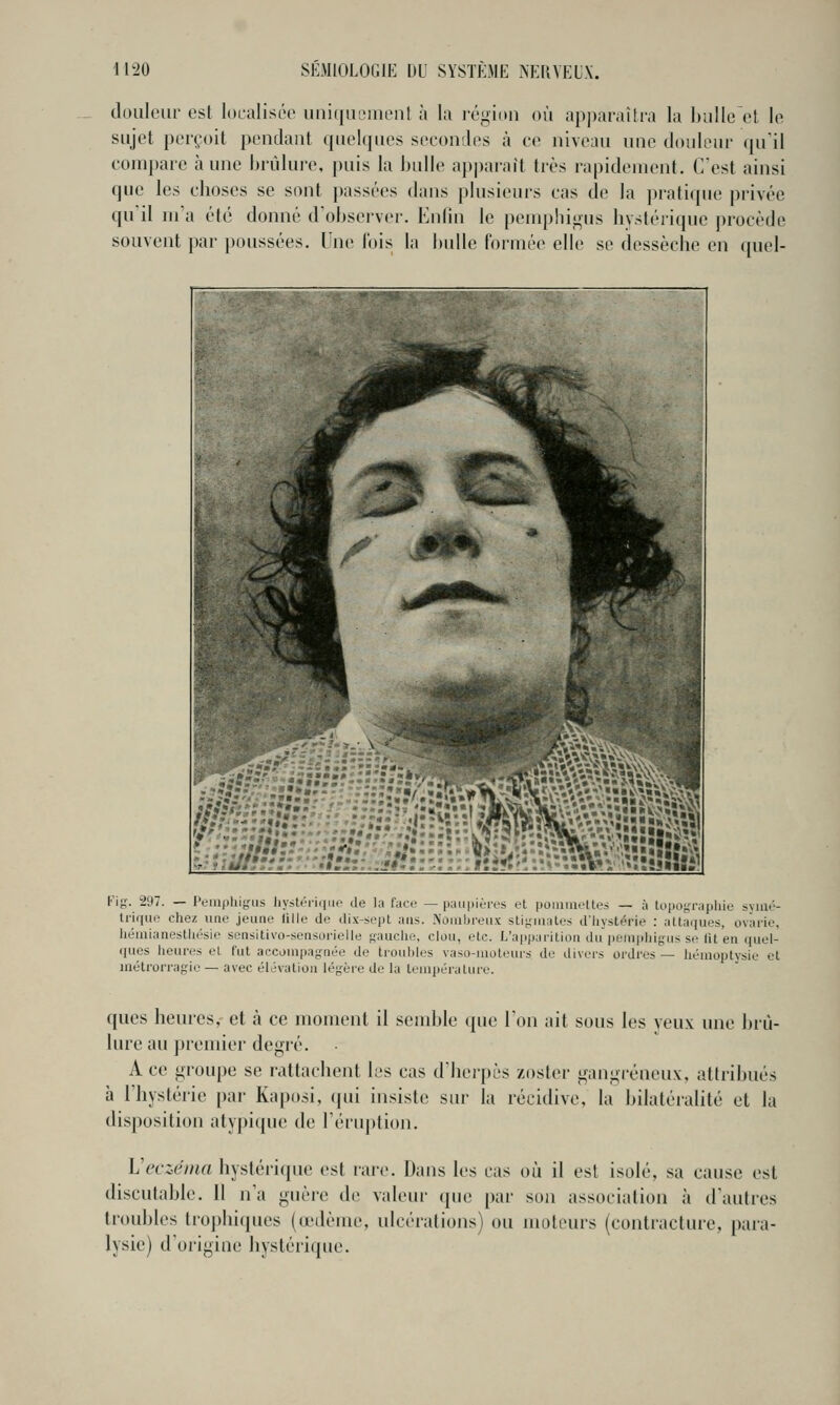 doiileiii' est localisée uiiiquL'iiienf à la région où apparaîtra la ballc'ct le sujet perçoit pendant quelques secondes à ce niveau une douleur qu'il compare hune brûlure, puis la bulle apparaît très rapidement. C'est ainsi que les clioses se sont passées dans plusieurs cas de la pratique privée quil m'a été donné d'observer. Enfin le pemphigus bystériquc procède souvent |)ar poussées. Une l'ois la bulle formée elle se dessèche en quel- Fig. 297. — Pempliigus hystérùiuo de la face — paupiùrcs ft poinineltes — à topographie symé- trique chez une jeune fille de dix-sept ans. Nûuihreux stiyiiiales d'hystérie : attaques, ovàrie, hémlanesthésie sensitivo-sensorielle f;i>uclie, clou, etc. L'apparition du peniphigus se fit en quel- ques heures et fut accompagnée de trouilles vaso-moteurs de divers ordres — hémojitysie et inétrorragie — avec élévation légère de la température. ques heures, et à ce moment il semble que l'on ait sous les yeux une brû- lure au premier degré. Ace groupe se rattachent les cas d'herpès zosler gangreneux, attribués à l'hystérie par Kaposi, qui insiste sur la récidive, la bilatéralité et la disposition atypique de rériq)tion. Veczéma hystérique est rare. Dans les cas où il est isolé, sa cause est discutable. Il n'a guère de valeur ([ue par son association à d'autres troubles tiophi(|ues (œdème, ulcérations) ou moteurs (contracture, para- lysie) d'origine hystérique.