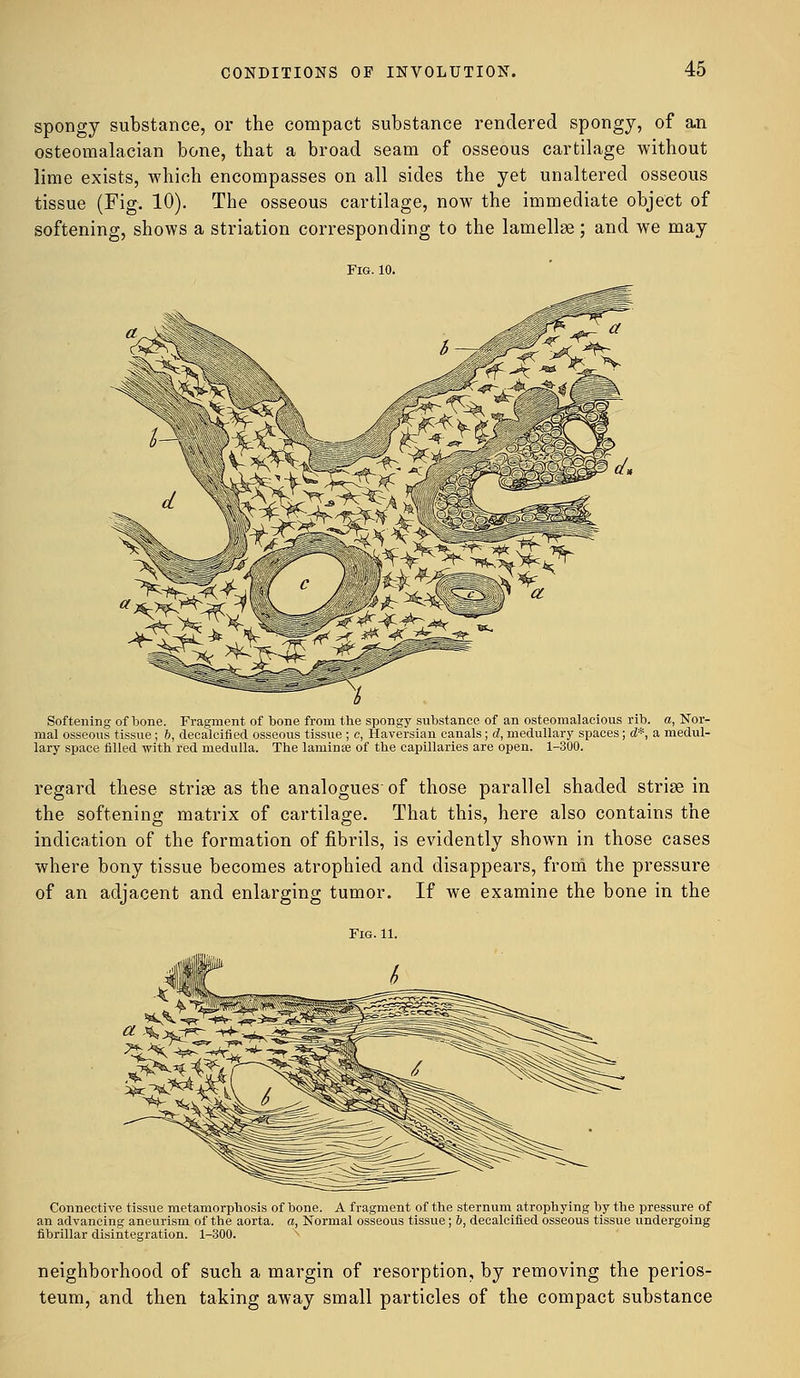 spongy substance, or the compact substance rendered spongy, of an osteomalacian bone, that a broad seam of osseous cartilage without lime exists, which encompasses on all sides the yet unaltered osseous tissue (Fig. 10). The osseous cartilage, now the immediate object of softening, shows a striation corresponding to the lamellae; and we may Softening of bone. Fragment of bone from the spongy substance of an osteomalacious rib. a, Nor- mal osseous tissue; b, decalcified osseous tissue ; c, Haversian canals; d, medullary spaces; d*, a medul- lary space filled with red medulla. The lamina? of the capillaries are open. 1-300. regard these striae as the analogues'of those parallel shaded striae in the softening matrix of cartilage. That this, here also contains the indication of the formation of fibrils, is evidently shown in those cases where bony tissue becomes atrophied and disappears, from the pressure of an adjacent and enlarging tumor. If we examine the bone in the Connective tissue metamorphosis of bone. A fragment of the sternum atrophying by the pressure of an advancing aneurism of the aorta, a, Normal osseous tissue; 6, decalcified osseous tissue undergoing fibrillar disintegration. 1-300. neighborhood of such a margin of resorption, by removing the perios- teum, and then taking away small particles of the compact substance