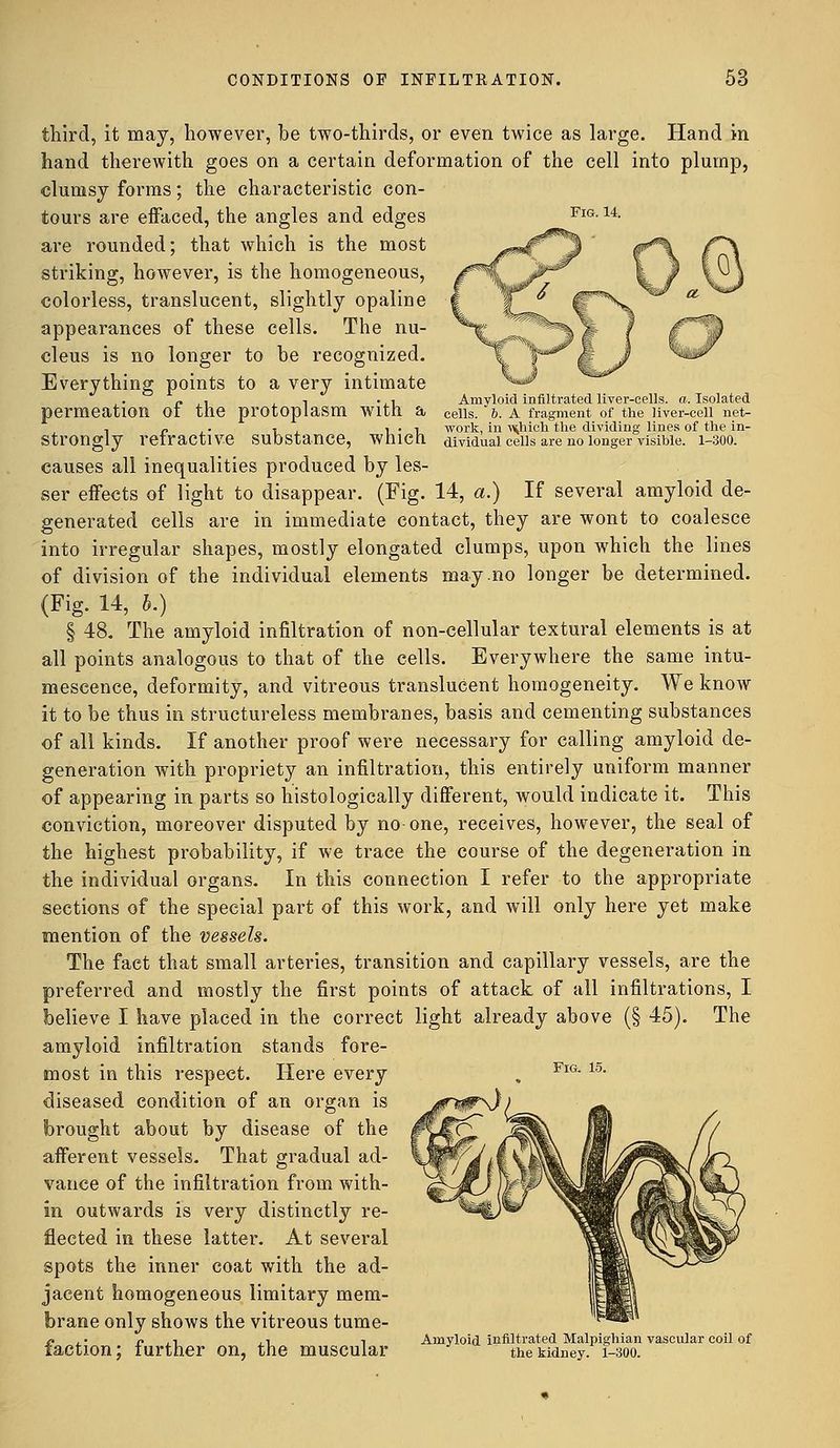 Amyloid infiltrated liver-cells, a. Isolated cells. 6. A fragment of the liver-cell net- work, in vtfiich the dividing lines of the in- dividual cells are no longer visible. 1-300. third, it may, however, be two-thirds, or even twice as large. Hand in hand therewith goes on a certain deformation of the cell into plump, clumsy forms; the characteristic con- tours are effaced, the angles and edges are rounded; that which is the most striking, however, is the homogeneous, colorless, translucent, slightly opaline appearances of these cells. The nu- cleus is no longer to he recognized. Everything points to a very intimate permeation of the protoplasm with a strongly refractive substance, which causes all inequalities produced by les- ser effects of light to disappear. (Fig. 14, a.) If several amyloid de- generated cells are in immediate contact, they are wont to coalesce into irregular shapes, mostly elongated clumps, upon which the lines of division of the individual elements may no longer be determined. (Fig. 14, b.) § 48. The amyloid infiltration of non-cellular textural elements is at all points analogous to that of the cells. Everywhere the same intu- mescence, deformity, and vitreous translucent homogeneity. We know it to be thus in structureless membranes, basis and cementing substances of all kinds. If another proof were necessary for calling amyloid de- generation with propriety an infiltration, this entirely uniform manner of appearing in parts so histologically different, would indicate it. This conviction, moreover disputed by no-one, receives, however, the seal of the highest probability, if we trace the course of the degeneration in the individual organs. In this connection I refer to the appropriate sections of the special part of this work, and will only here yet make mention of the vessels. The fact that small arteries, transition and capillary vessels, are the preferred and mostly the first points of attack of all infiltrations, I believe I have placed in the correct light already above (§ 45). The amyloid infiltration stands fore- most in this respect. Here every diseased condition of an organ is brought about by disease of the afferent vessels. That gradual ad- vance of the infiltration from with- in outwards is very distinctly re- flected in these latter. At several spots the inner coat with the ad- jacent homogeneous limitary mem- brane only shows the vitreous tume- fy p , i , i i Amyloid infiltrated Malpighian vascular coil of taction; further on, the muscular the kidney. 1-300. Fig. 15.
