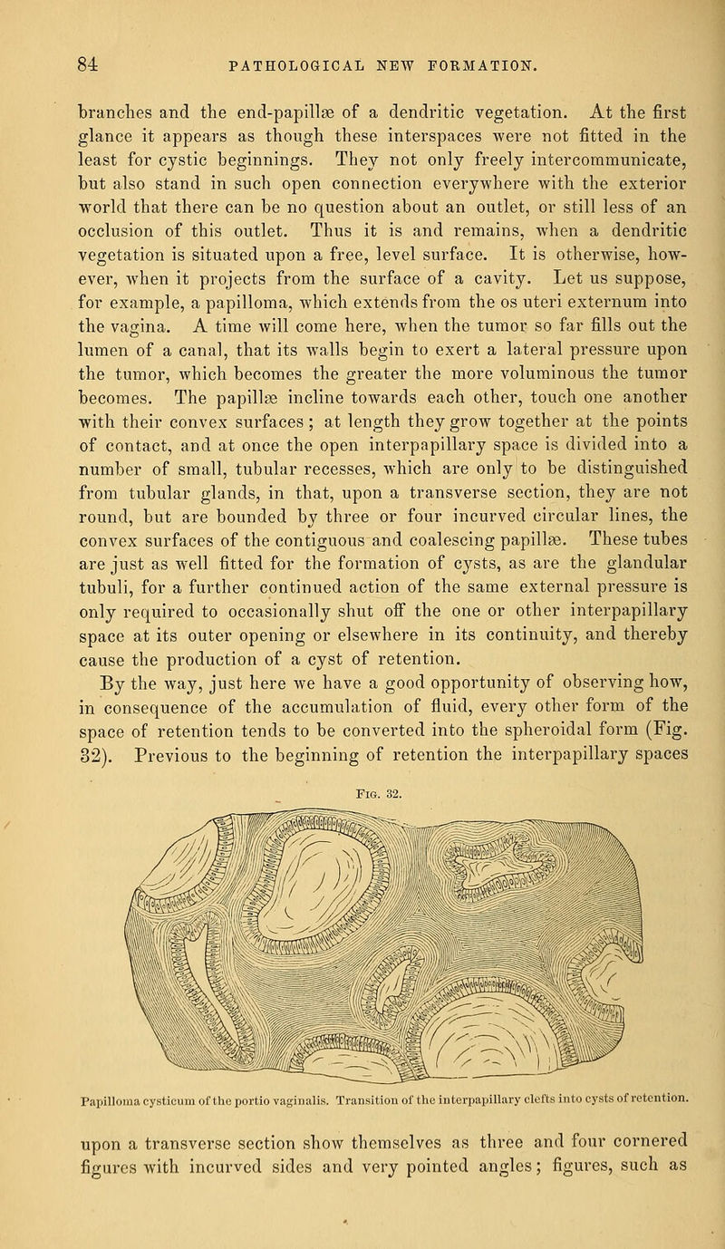 branches and the end-papillae of a dendritic vegetation. At the first glance it appears as though these interspaces were not fitted in the least for cystic beginnings. They not only freely intercommunicate, but also stand in such open connection everywhere with the exterior world that there can be no question about an outlet, or still less of an occlusion of this outlet. Thus it is and remains, when a dendritic vegetation is situated upon a free, level surface. It is otherwise, how- ever, when it projects from the surface of a cavity. Let us suppose, for example, a papilloma, which extends from the os uteri externum into the vagina. A time will come here, when the tumor so far fills out the lumen of a canal, that its walls begin to exert a lateral pressure upon the tumor, which becomes the greater the more voluminous the tumor becomes. The papillae incline towards each other, touch one another with their convex surfaces ; at length they grow together at the points of contact, and at once the open interpapillary space is divided into a number of small, tubular recesses, which are only to be distinguished from tubular glands, in that, upon a transverse section, they are not round, but are bounded by three or four incurved circular lines, the convex surfaces of the contiguous and coalescing papillae. These tubes are just as well fitted for the formation of cysts, as are the glandular tubuli, for a further continued action of the same external pressure is only required to occasionally shut off the one or other interpapillary space at its outer opening or elsewhere in its continuity, and thereby cause the production of a cyst of retention. By the way, just here we have a good opportunity of observing how, in consequence of the accumulation of fluid, every other form of the space of retention tends to be converted into the spheroidal form (Fig. 32). Previous to the beginning of retention the interpapillary spaces Fig. 32. ^^T^ Papilloma cysticum of the portio vaginalis. Transition of the interpapillary clefts into cysts of retention. upon a transverse section show themselves as three and four cornered figures with incurved sides and very pointed angles; figures, such as