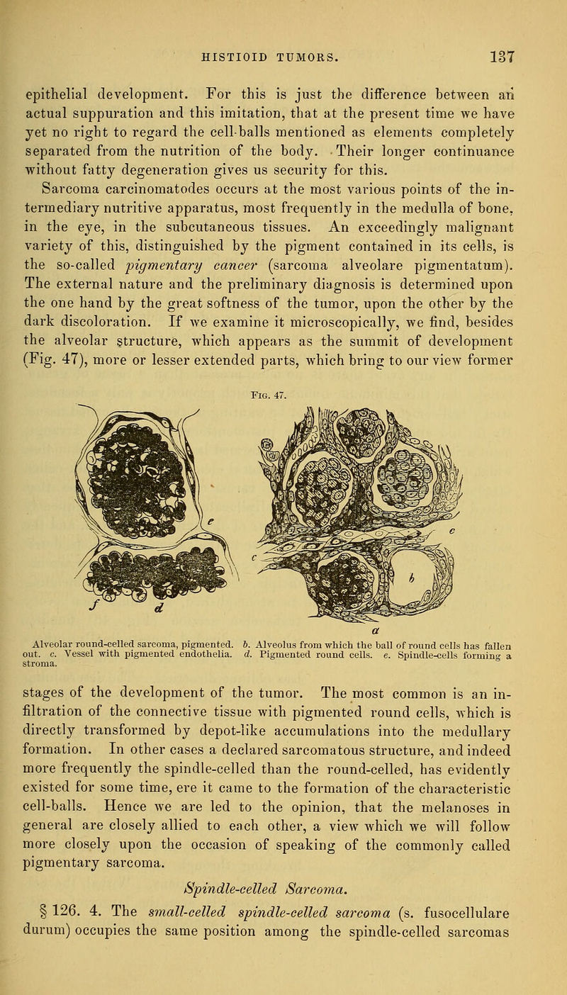 epithelial development. For this is just the difference between an actual suppuration and this imitation, that at the present time we have yet no right to regard the cell-balls mentioned as elements completely separated from the nutrition of the body. Their longer continuance without fatty degeneration gives us security for this. Sarcoma carcinomatodes occurs at the most various points of the in- termediary nutritive apparatus, most frequently in the medulla of bone, in the eye, in the subcutaneous tissues. An exceedingly malignant variety of this, distinguished by the pigment contained in its cells, is the so-called pigmentary cancer (sarcoma alveolare pigmentatum). The external nature and the preliminary diagnosis is determined upon the one hand by the great softness of the tumor, upon the other by the dark discoloration. If we examine it microscopically, we find, besides the alveolar structure, which appears as the summit of development (Fig. 47), more or lesser extended parts, which bring to our view former Fig. 47. Alveolar round-celled sarcoma, pigmented. 6. Alveolus from which the ball of round cells has fallen out. c. Vessel with pigmented endothelia. d. Pigmented round cells, e. Spindle-cells forming a stroma. stages of the development of the tumor. The most common is an in- filtration of the connective tissue with pigmented round cells, which is directly transformed by depot-like accumulations into the medullary formation. In other cases a declared sarcomatous structure, and indeed more frequently the spindle-celled than the round-celled, has evidently existed for some time, ere it came to the formation of the characteristic cell-balls. Hence we are led to the opinion, that the melanoses in general are closely allied to each other, a view which we will follow more closely upon the occasion of speaking of the commonly called pigmentary sarcoma. Spindle-celled Sarcoma. § 126. 4. The small-celled spindle-celled sarcoma (s. fusocellulare durum) occupies the same position among the spindle-celled sarcomas