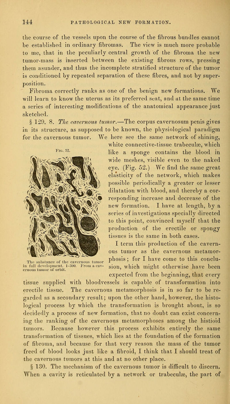 the course of the vessels upon the course of the fibrous bundles cannot be established in ordinary fibromas. The view is much more probable to me, that in the peculiarly central growth of the fibroma the new tumor-mass is inserted between the existing fibrous rows, pressing them asunder, and thus the incomplete stratified structure of the tumor is conditioned by repeated separation of these fibres, and not by super- position. Fibroma correctly ranks as one of the benign new formations. We will learn to know the uterus as its preferred scat, and at the same time a series of interesting modifications of the anatomical appearance just sketched. § 129. 8. The cavernous tumor.—The corpus cavernosum penis gives in its structure, as supposed to be known, the physiological paradigm for the cavernous tumor. We here see the same network of shining, white connective-tissue trabecule, which FlG'52- like a sponge contains the blood in wide meshes, visible even to the naked eye. (Fig. 52.) We find the same great elasticity of the network, which makes possible periodically a greater or lesser dilatation with blood, and thereby a cor- responding increase and decrease of the new formation. I have at length, by a series of investigations specially directed to this point, convinced myself that the production of the erectile or spongy tissues is the same in- both cases. I term this production of the cavern- ous tumor as the cavernous metamor- phosis ; for I have come to this conclu- sion, which might otherwise have been expected from the beginning, that every tissue supplied with bloodvessels is capable of transformation into erectile tissue. The cavernous metamorphosis is in so far to be re- garded as a secondary result; upon the other hand, however, the histo- logical process by which the transformation is brought about, is so decidedly a process of new formation, that no doubt can exist concern- ing the ranking of the cavernous metamorphoses among the histioid tumors. Because however this process exhibits entirely the same transformation of tissues, which lies at the foundation of the formation of fibroma, and because for that very reason the mass of the tumor freed of blood looks just like a fibroid, I think that I should treat of the cavernous tumors at this and at no other place. § 130. The mechanism of the cavernous tumor is difficult to discern. When a cavity is reticulated by a network or trabecule, the part of The substance of the cavernous tumor in full development. 1-300. From a cav- ernous tumor of orbit.