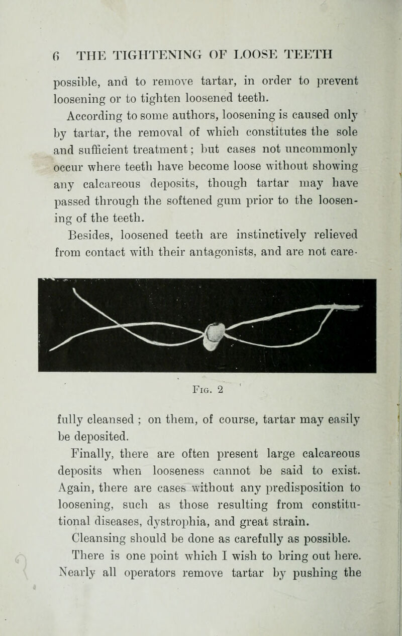 possible, and to remove tartar, in order to jn-event loosening or to tighten loosened teeth. According to some authors, loosening is caused only by tartar, the removal of which constitutes the sole and sufficient treatment; but cases not uncommonly occur where teeth have become loose without showing any calcareous deposits, though tartar may have passed through the softened gum prior to the loosen- ing of the teeth. Besides, loosened teeth are instinctively relieved from contact with their antagonists, and are not care- Fig. 2 <r fully cleansed ; on them, of course, tartar may easily be deposited. Finally, there are often present large calcareous deposits when looseness cannot be said to exist. Again, there are cases without any predisposition to loosening, such as those resulting from constitu- tional diseases, dystrophia, and great strain. Cleansing should be done as carefully as possible. There is one point which I wish to bring out here. Nearly all operators remove tartar by pushing the