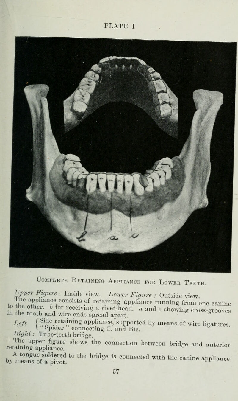 Complete Eetaixing Appliance for Lower Teeth. TJpper Figure: Inside view. Lower Figure ; Outside view, fn \hl ^Pli^-i^fe^onsists of retaining appliance running from one canine in S! f fu' ^^/o^;^'^'^g ^ nvet-head. a and c showing cross-grooves in the tooth and wire ends spread apart. e u^et, ^eft I Side retaining apphance, supported by means of wire ligatures I hpider connecting C. and Bic. Right: Tube-teeth bridge. retllning'^^^hlSr ''°' *'' '°'^^ '^^^^ '^^^^ ^^ ^^--^ by mtT^ff ph' *' *'' ''' '°^^*^' ^*^ *^^ ^^^- ^PP^-°- 57