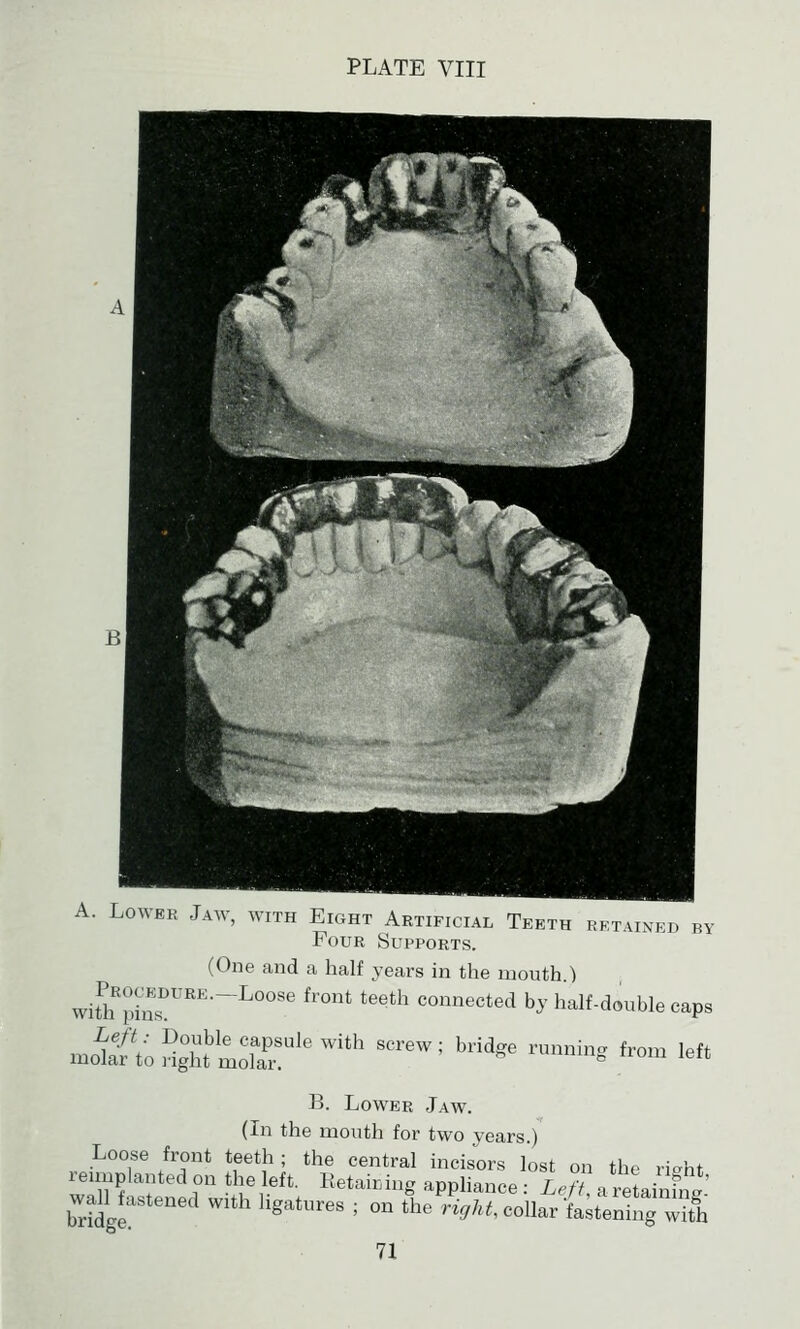 A. Lower Jaw, with Eight Artificial Teeth HKTAixKn by Four Supports. (One and a half years in the mouth ) wi^M.iiS!''''''^''' ^'°''^ ^''^^ connected by half-double caps mo^aftoHghtmolTr^'^'' = ''''''' ^^» ,f-- '^'^ B. Lower Jaw. (In the mouth for two years.) Loose front teeth; the central incisors lost on the ris^ht reimplanted on the left. Retairing appliance : Lef^, a retainfn ' w^Hastened with ligatures ; on the W,/.^, collar •fa;tenhigwfh