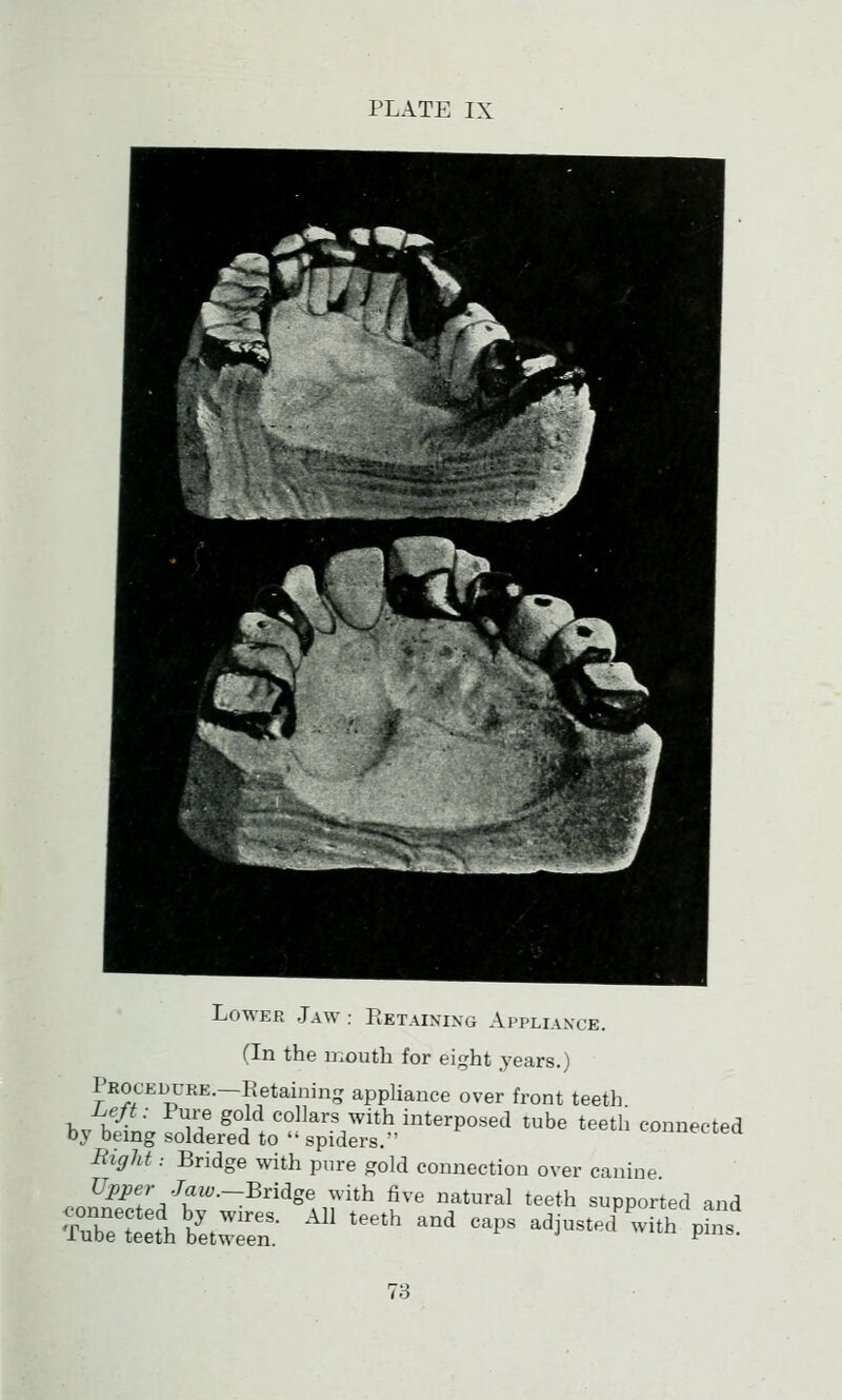 Lower Jaw : Retaixing Appliance. (In the mouth for eight years.) Procedure.—Retaining appliance over front teeth i.e/^- Pure gold collars with interposed tube teeth connected by being soldered to spiders. i^nufcoea Right: Bridge vvith pure gold connection over canine Upper Jaw.-Bridge with five natural teeth supported and iTeTltZ^: ^' ^ ^^^ -^^ ad,usted^^with p^l'