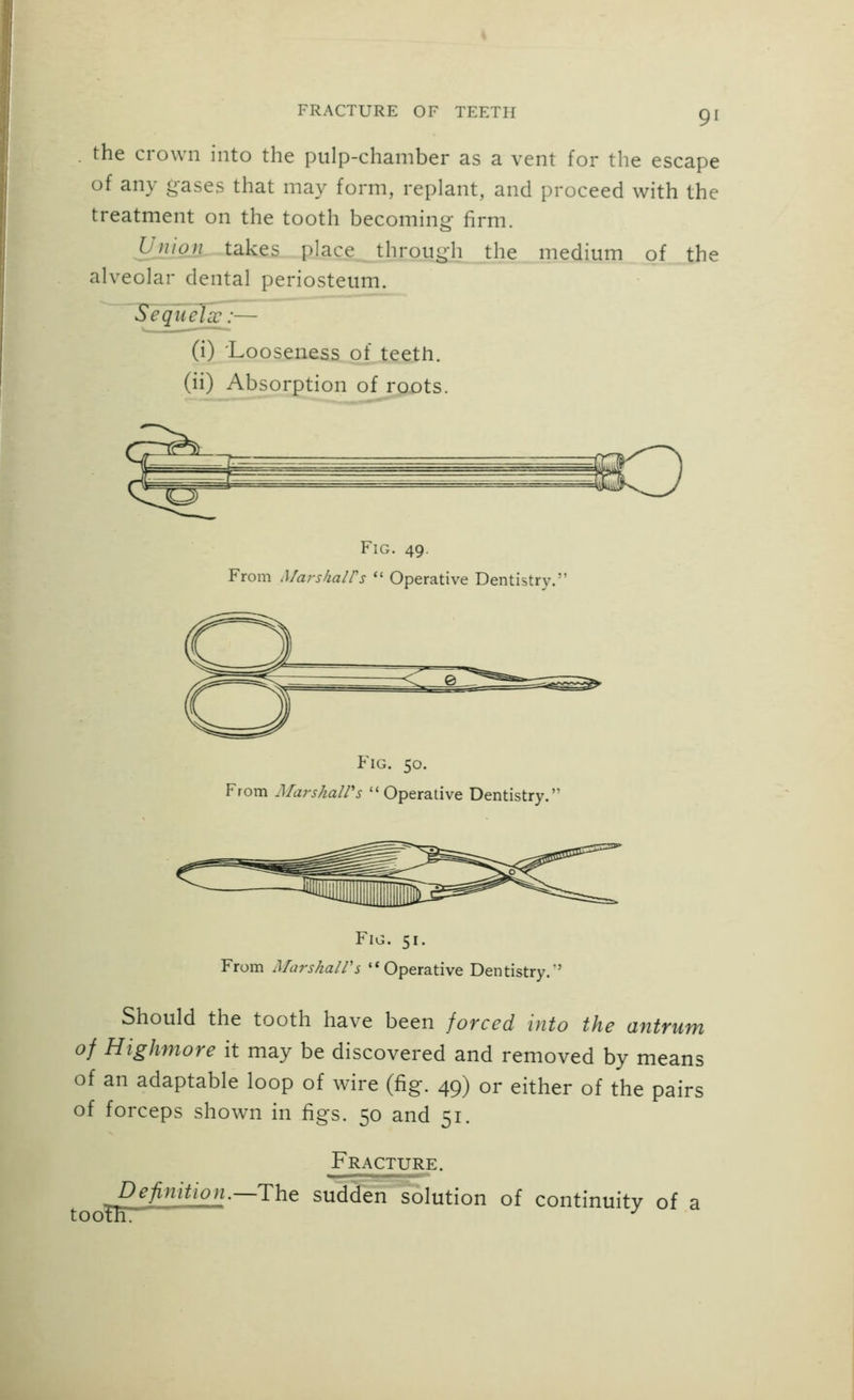 9' the crown into the pulp-chamber as a vent for the escape of any gases that may form, replant, and proceed with the treatment on the tooth becoming firm. Union takes place through the medium of the alveolar dental periosteum. Sequelx:— (i) Looseness of teeth, (ii) Absorption of roots. Fig. 49. From MarskalVs  Operative Dentistry. Fig. 50. From Marshall's Operative Dentistry. Fig. 51. From MarshalVs '* Operative Dentistry.' Should the tooth have been forced into the antrum of Highmore it may be discovered and removed by means of an adaptable loop of wire (fig. 49) or either of the pairs of forceps shown in figs. 50 and 51. Fracture. Definition.—Tht sudden solution of continuity of a