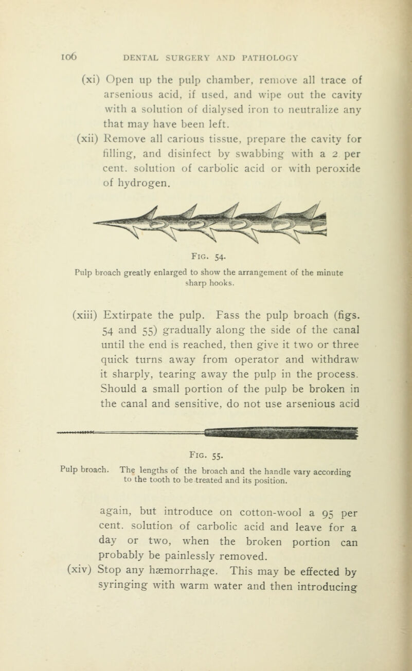 (xi) open up the pulp chamber, remove all trace of arsenious acid, if used, and wipe out the cavity with a solution of dialysed iron to neutralize any that may have been left, (xii) Remove all carious tissue, prepare the cavity for filling, and disinfect by swabbing with a 2 per cent, solution of carbolic acid or with peroxide of hydrogen. Fig. 54. Pulp broach greatly enlarged to show the arrangement of the minute sharp hooks. (xiii) Extirpate the pulp. Fass the pulp broach (ligs. 54 and 55) gradually along the side of the canal until the end is reached, then give it two or three quick turns away from operator and withdraw it sharply, tearing away the pulp in the process. Should a small portion of the pulp be broken in the canal and sensitive, do not use arsenious acid Fig. 55. Pulp broach. The lengths of the broach and the handle vary according to the tooth to be treated and its position. again, but introduce on cotton-wool a 95 per cent, solution of carbolic acid and leave for a day or two, when the broken portion can probably be painlessly removed, (xiv) Stop any haemorrhage. This may be effected by syringing with warm water and then introducing