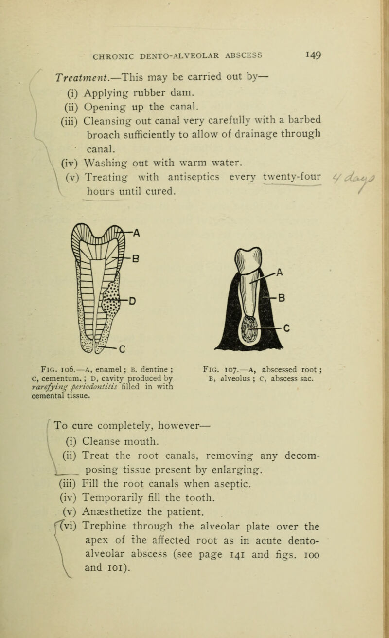 Treatment.—This may be carried out by— (i) Applying rubber dam. (ii) Opening up the canal. (iii) Cleansing out canal very carefully with a barbed broach sufficiently to allow of drainage through canal. (iv) Washing out w'ith warm water. \ (v) Treating with antiseptics every twenty-four ^ d^^^ hours until cured. / Fig. 106.—A, enamel; b. dentine ; C, cementum. ; D, cavity produced by rarefying periodontitis tilled in with cemental tissue. Fig. 107.—A, abscessed root ; B, alveolus ; C, abscess sac. To cure completely, however— (i) Cleanse mouth. (ii) Treat the root canals, removing any decom- posing tissue present by enlarging. (iii) Fill the root canals when aseptic. (iv) Temporarily fill the tooth. (v) Anaesthetize the patient. (vi) Trephine through the alveolar plate over the apex of the affected root as in acute dento- alveolar abscess (see page 141 and figs. 100 and loi).