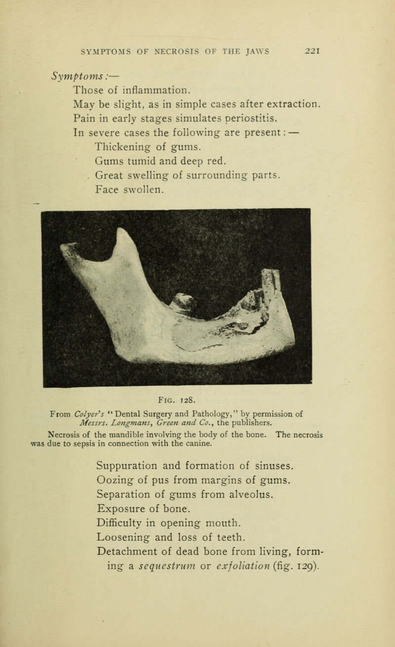 SYMPTOMS OF NECROSIS OF THE JAWS 221 Symptoms:— Those of inflammation. May be slight, as in simple cases after extraction, Pain in early stages simulates periostitis. In severe cases the following are present: — Thickening of gums. Gums tumid and deep red. . Great swelling of surrounding parts. Face swollen. Fig. 128. From Colyer''s *' Dental Surgery and Pathology, by permission of Messrs. Long?nans, Green and Co., the publishers. Necrosis of the mandible involving the body of the bone. The necrosis was due to sepsis in connection with the canine. Suppuration and formation of sinuses. Oozing of pus from margins of gums. Separation of gums from alveolus. Exposure of bone. Difficulty in opening mouth. Loosening and loss of teeth. Detachment of dead bone from living, form- ing a sequestrum or exfoliation (fig. 129).