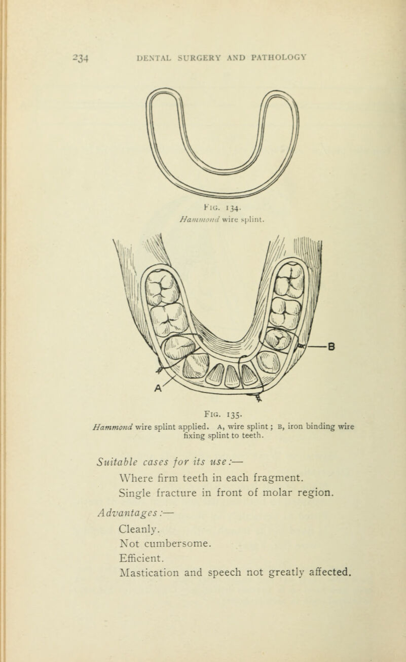 hiG. 134. Naiunioini wire spliiu. B Fir.. 135- Hammond wire splint applied. A, wire splint; B, iron binding wire fixing splint to teeth. Suitable cases for its use:— Where firm teeth in each fragment. Single fracture in front of molar region. Advantages:— Cleanly. Not cumbersome. Efficient. Mastication and speech not greatly affected.