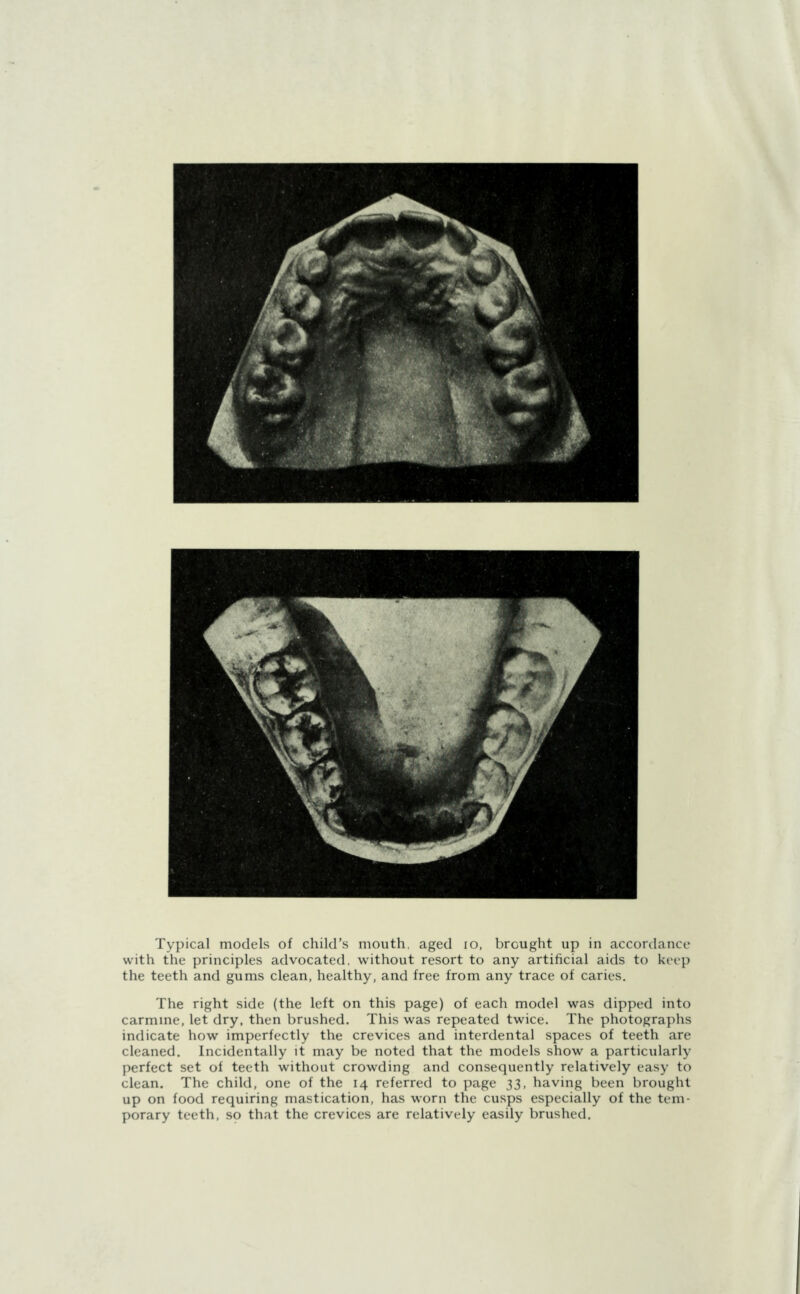 Typical models of child's mouth, aged 10, brought up in accordance with the principles advocated, without resort to any artificial aids to keep the teeth and gums clean, healthy, and free from any trace of caries. The right side (the left on this page) of each model was dipped into carmine, let dry, then brushed. This was repeated twice. The photographs indicate how imperfectly the crevices and interdental spaces of teeth are cleaned. Incidentally it may be noted that the models show a particularly perfect set of teeth without crowding and consequently relatively easy to clean. The child, one of the 14 referred to page 33, having been brought up on food requiring mastication, has worn the cusps especially of the tem- porary teeth, so that the crevices are relatively easily brushed.