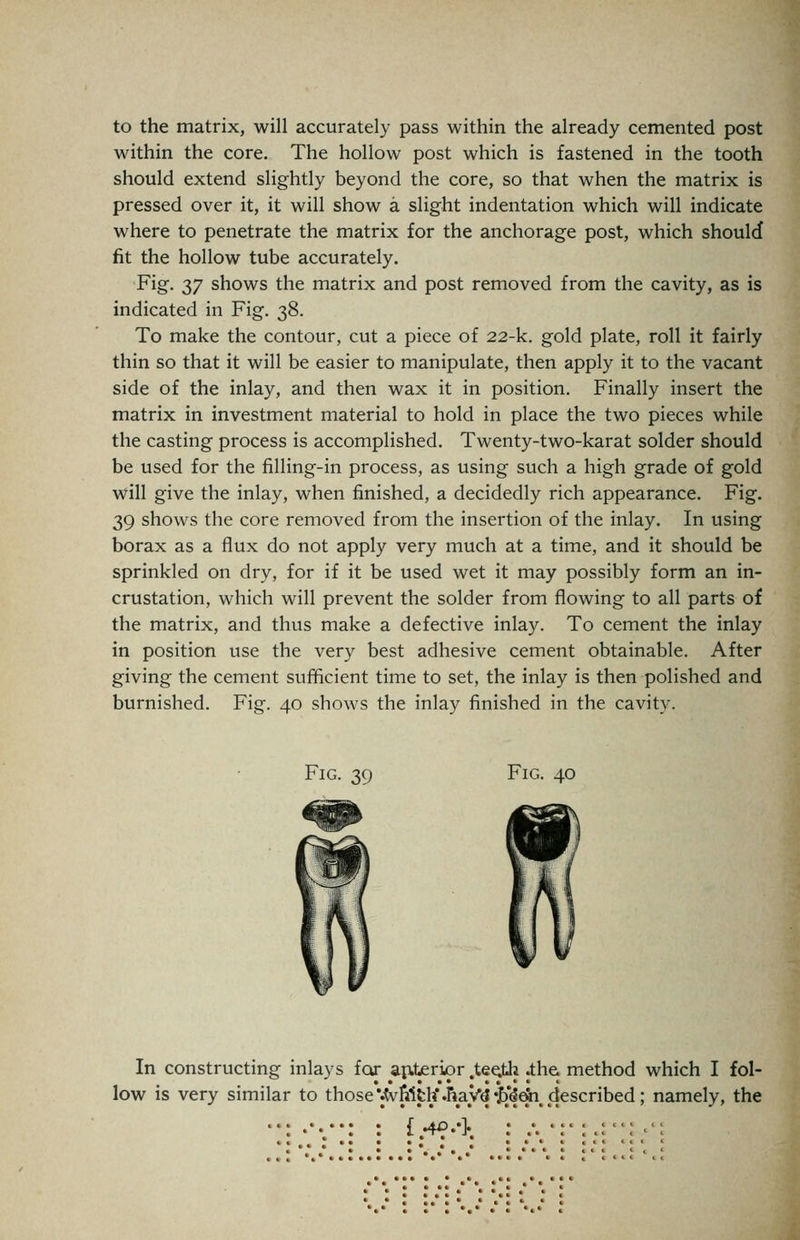 to the matrix, will accurately pass within the already cemented post within the core. The hollow post which is fastened in the tooth should extend slightly beyond the core, so that when the matrix is pressed over it, it will show a slight indentation which will indicate where to penetrate the matrix for the anchorage post, which should fit the hollow tube accurately. Fig. 37 shows the matrix and post removed from the cavity, as is indicated in Fig. 38. To make the contour, cut a piece of 22-k. gold plate, roll it fairly thin so that it will be easier to manipulate, then apply it to the vacant side of the inlay, and then wax it in position. Finally insert the matrix in investment material to hold in place the two pieces while the casting process is accomplished. Twenty-two-karat solder should be used for the filling-in process, as using such a high grade of gold will give the inlay, when finished, a decidedly rich appearance. Fig. 39 shows the core removed from the insertion of the inlay. In using borax as a flux do not apply very much at a time, and it should be sprinkled on dry, for if it be used wet it may possibly form an in- crustation, which will prevent the solder from flowing to all parts of the matrix, and thus make a defective inlay. To cement the inlay in position use the very best adhesive cement obtainable. After giving the cement sufficient time to set, the inlay is then polished and burnished. Fig. 40 shows the inlay finished in the cavity. Fig. 39 Fig. 40 In constructing inlays for apterior .tee^th .the method which I fol- low is very similar to those'.tv&ith'.Ray^'^'^dn,described; namely, the