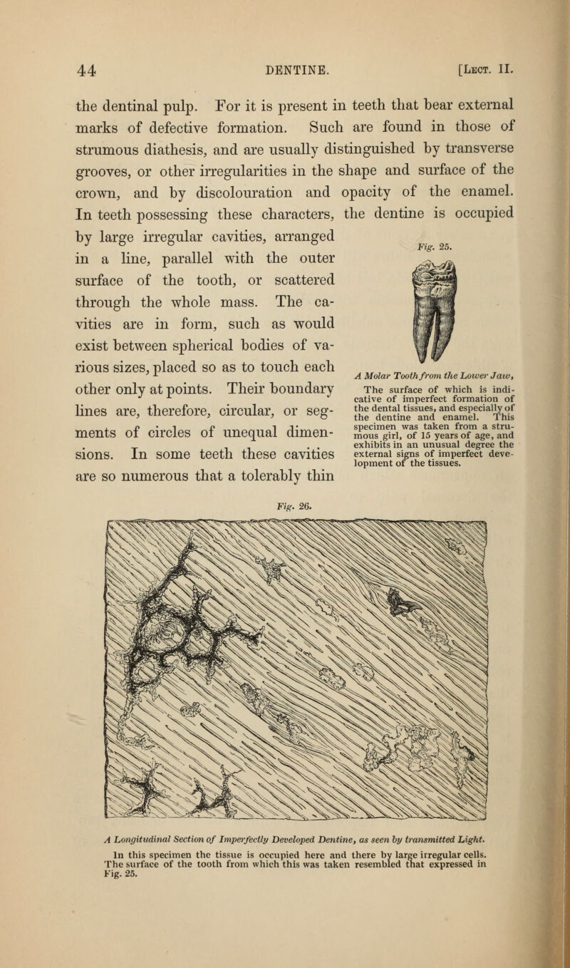 the dentinal pulp. For it is present in teeth that bear external marks of defective formation. Such are found in those of strumous diathesis, and are usually distinguished by transverse grooves, or other irregularities in the shape and surface of the crown, and by discolouration and opacity of the enamel. In teeth possessing these characters, the dentine is occupied by large irregular cavities, arranged in a line, parallel with the outer surface of the tooth, or scattered through the whole mass. The ca- vities are in form, such as would exist between spherical bodies of va- rious sizes, placed so as to touch each other only at points. Their boundary lines are, therefore, circular, or seg- ments of circles of unequal dimen- sions. In some teeth these cavities are so numerous that a tolerably thin Fig. 26. A Molar Tooth from the Lower Jaw, The surface of which is indi- cative of imperfect formation of the dental tissues, and especially of the dentine and enamel. This specimen was taken from a stru- mous girl, of 15 years of age, and exhibits in an unusual degree the external signs of imperfect deve- lopment of the tissues. A Longitudinal Section of Imperfectly Developed Dentine, as seen by transmitted Light. In this specimen the tissue is occupied here and there by large irregular cells. The surface of the tooth from which this was taken resembled tnat expressed in Fig. 25.