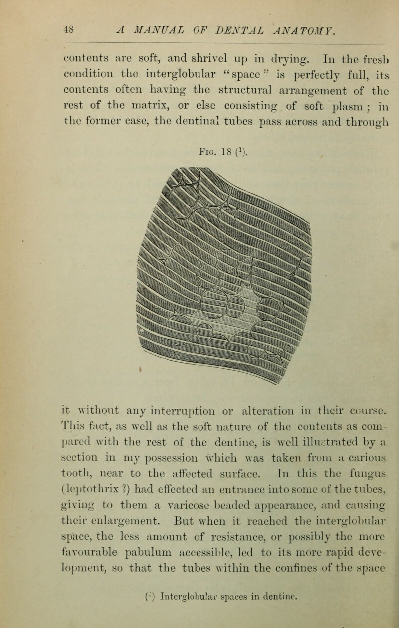 contents are soft, and shrivel up in drying. In the fresh condition the interglobular space is perfectly full, its contents often having the structural arrangement of the rest of the matrix, or else consisting of soft plasm ; in the former case, the dentinal tubes pass across and through Fig. 18 (1). it \vithout any interruption or alteration in their course. Tliis fact, as well as the soft nature of the contents as com- [)ared with the rest of the dentine, is well illustrated by a section in my possession which was taken from a carious tooth, near to the affected surface. In this the fungus (leptothrix ?) had effected an entrance into some of the tubes, giving to them a varicose beaded appearance, and causing their enlargement. But when it reached the interglobular space, the less amount of resistance, or possibly the more favourable pabulum accessible, led to its more rapid deve- lopment, so that the tubes within the confines of the space () Interglobular .spaces in dentine.