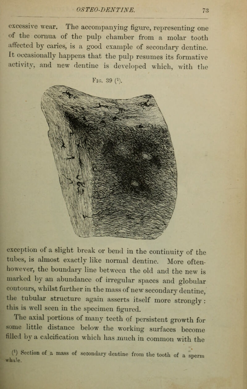 excessive wear. The accompanying figure, representing one of the cornua of the pulp chamber from a molar tooth affected by caries, is a good example of secondaiy dentine. It occasionally happens that the pulp resnmes its formative activity, and new dentine is developed which, with the Fig. 39 {}). ^iC^l: exception of a slight break or bend in the continuity of the tubes, is almost exactly like normal dentine. More often- however, the boundary line between the old and the new is marked by an abundance of irregular spaces and globular contours, whilst further in the mass of new secondary dentine, the tubular structure again asserts itself more strongly : this is well seen in the specimen figured. The axial portions of many teeth of persistent growth for some little distance below the working surfaces become filled by a calcification which has much in common with the (') Section of a mass of secondary dentine from tlie tooth of a spenn wh:ile.