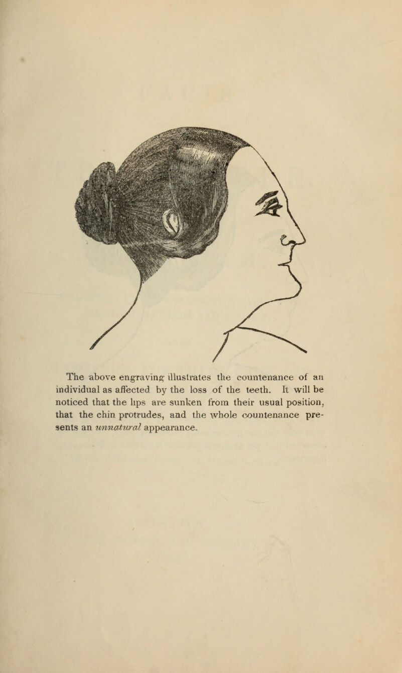 The above engraving illustrates the countenance of an individual as affected by the loss of the teeth. It will be noticed that the lips are sunken from their usual position, that the chin protrudes, and the whole ^x)untenance pre- sents an unnaUual appearance.